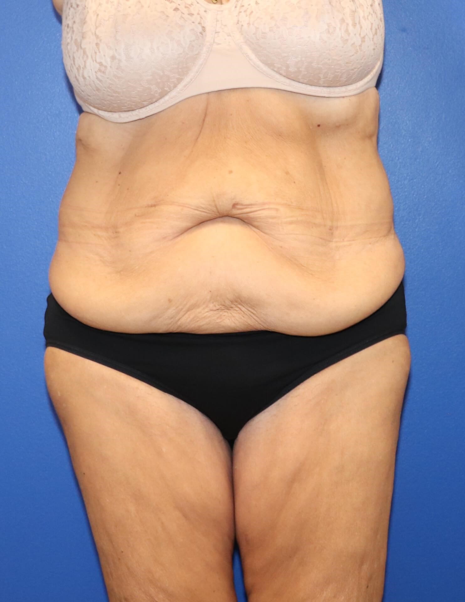 GLP weight loss abdominoplasty Before