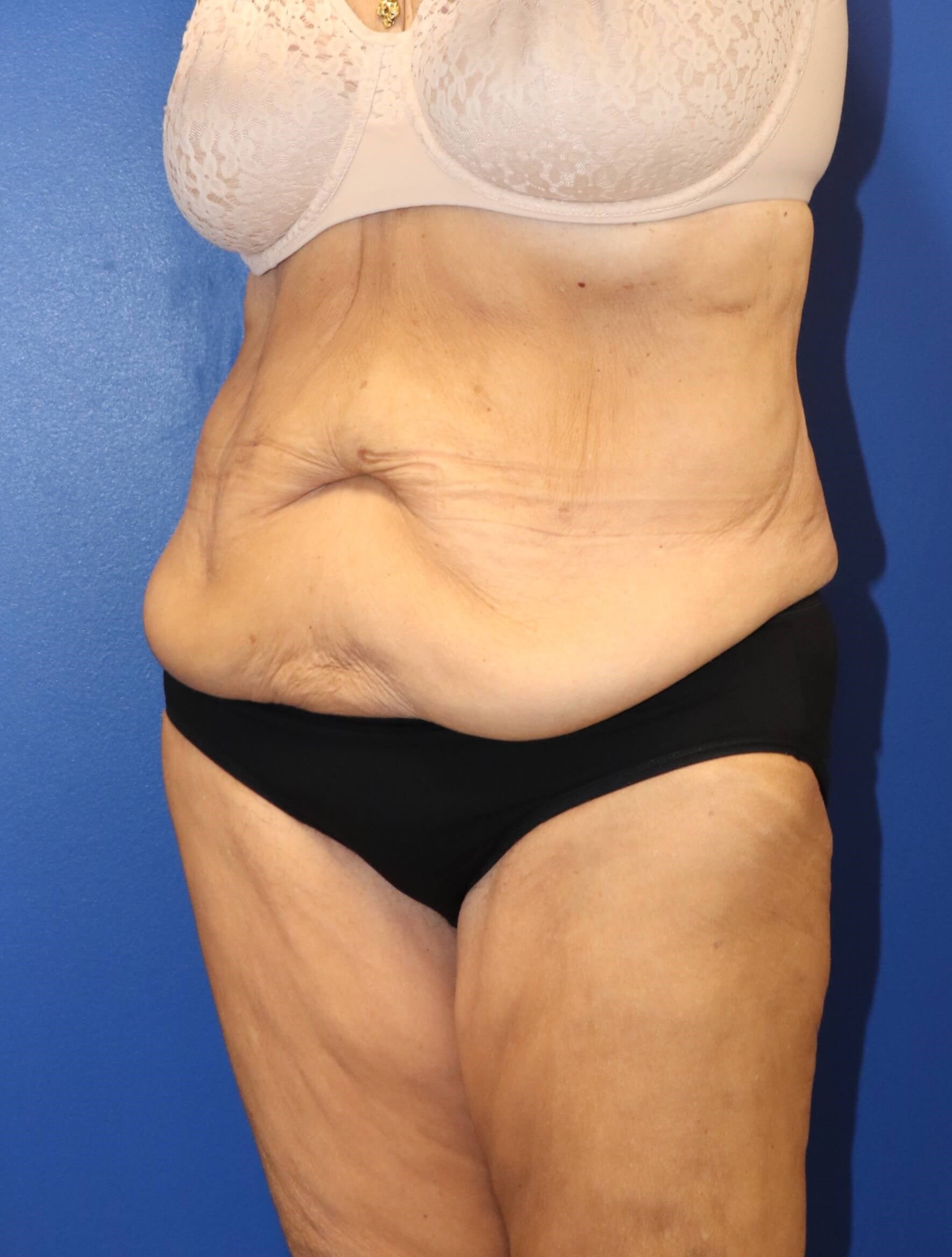 GLP weight loss abdominoplasty Before