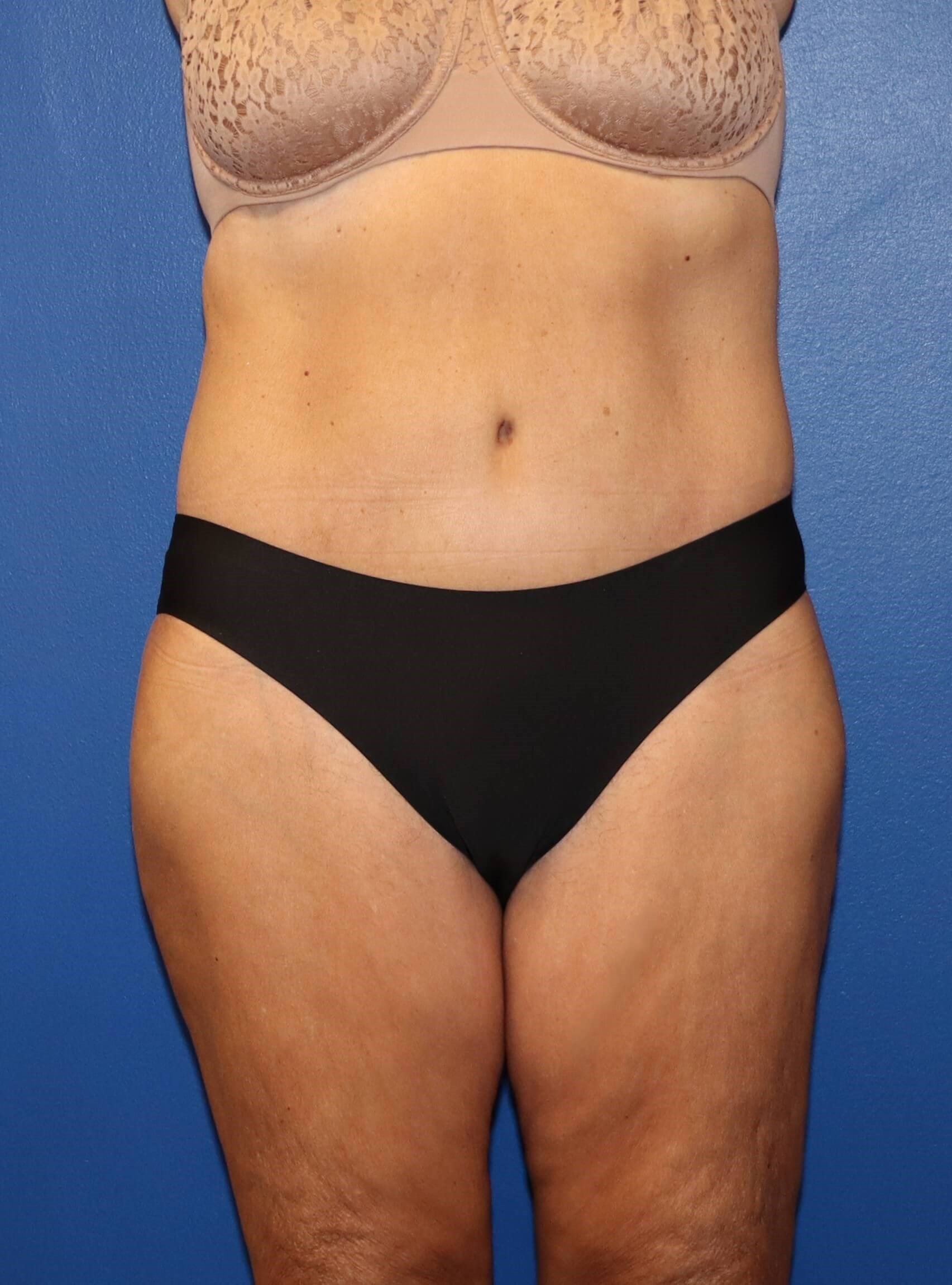 GLP weight loss abdominoplasty After
