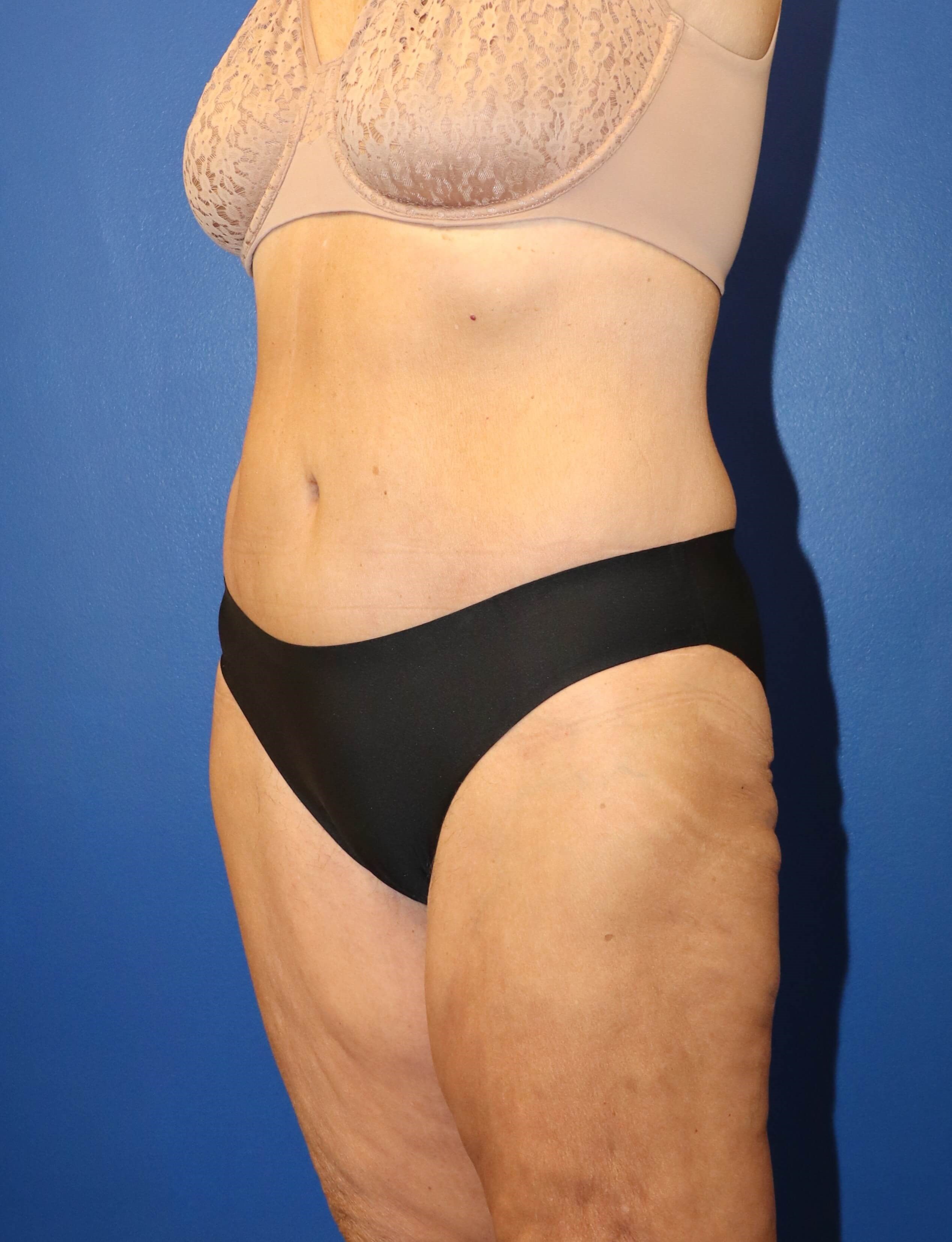 GLP weight loss abdominoplasty After