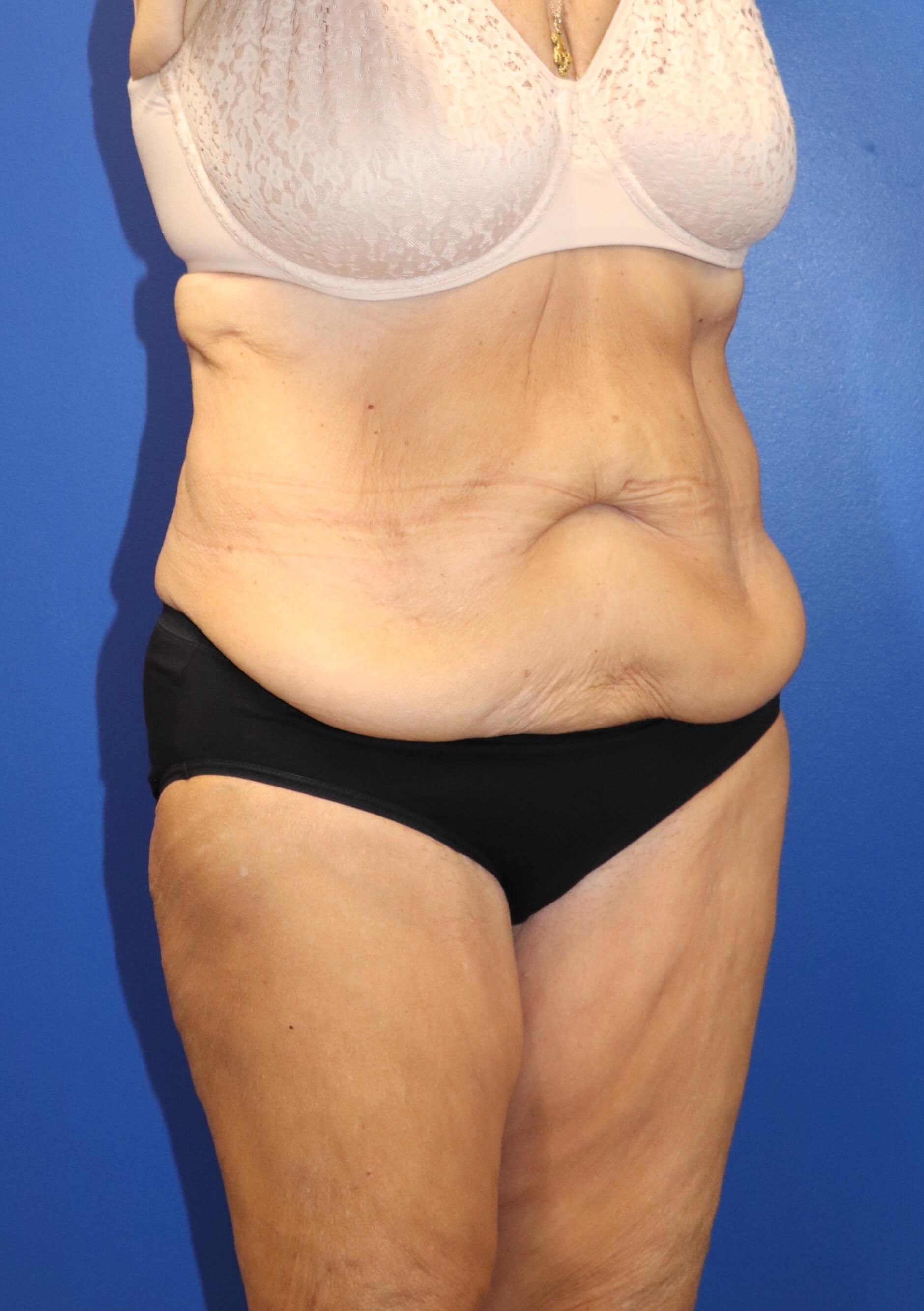 GLP weight loss abdominoplasty Before