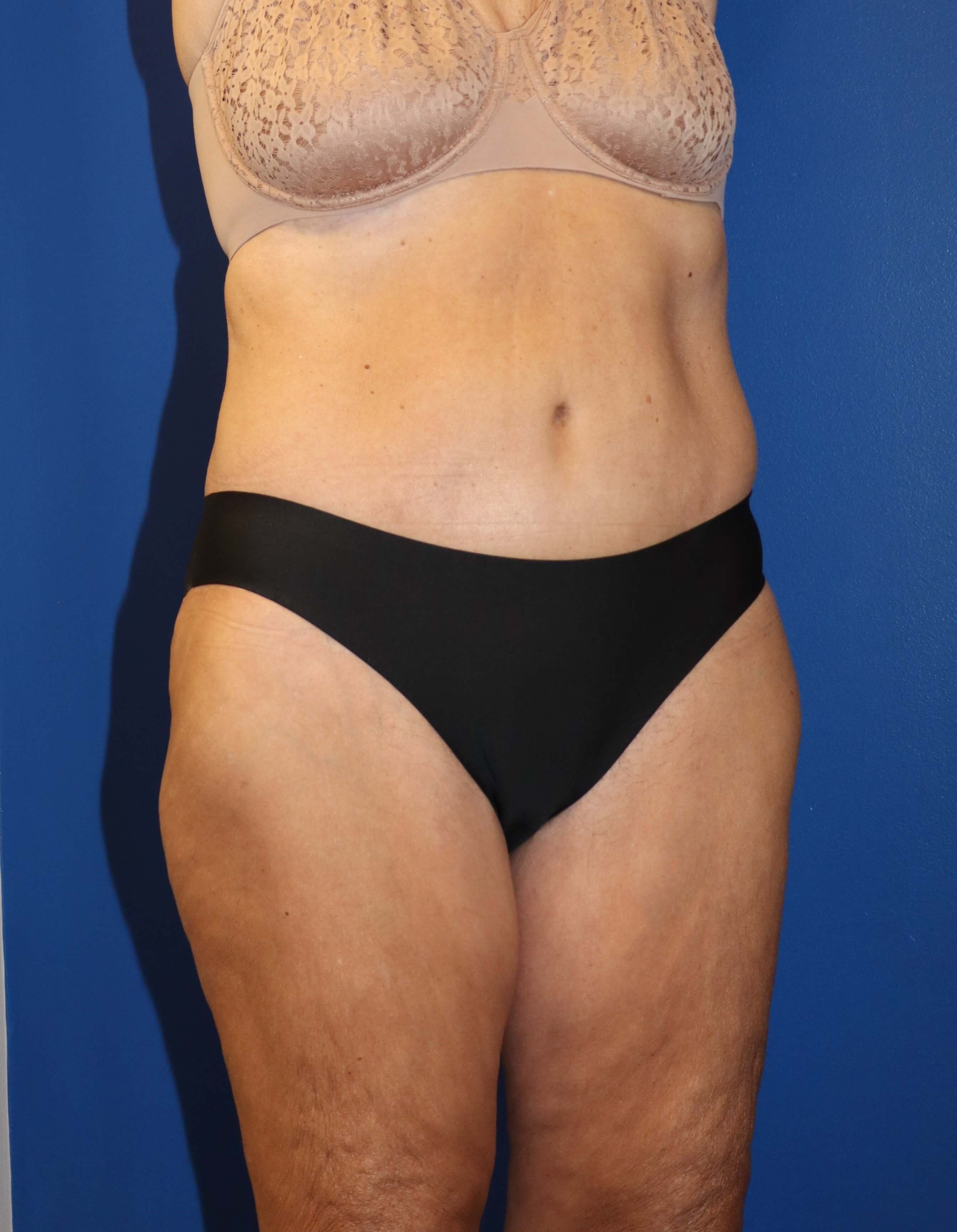 GLP weight loss abdominoplasty After