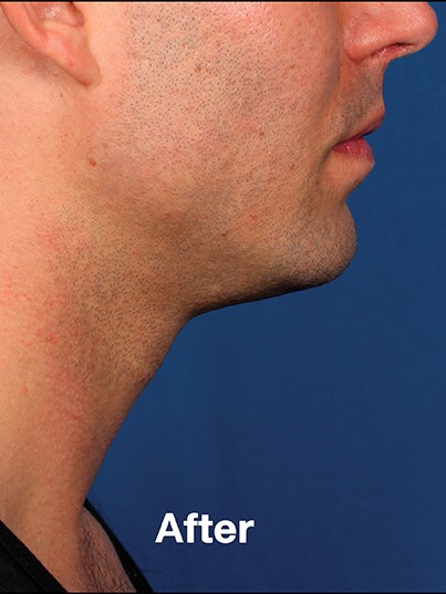 Side View After