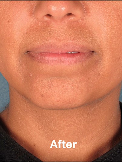 Front View After