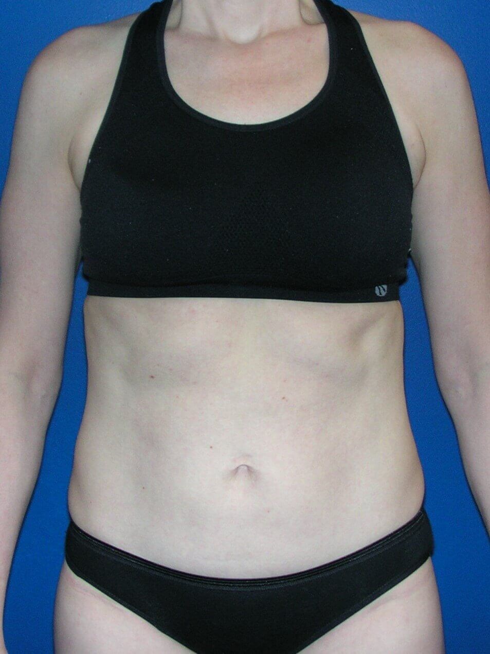 Sculpsure Fat Melting Laser After