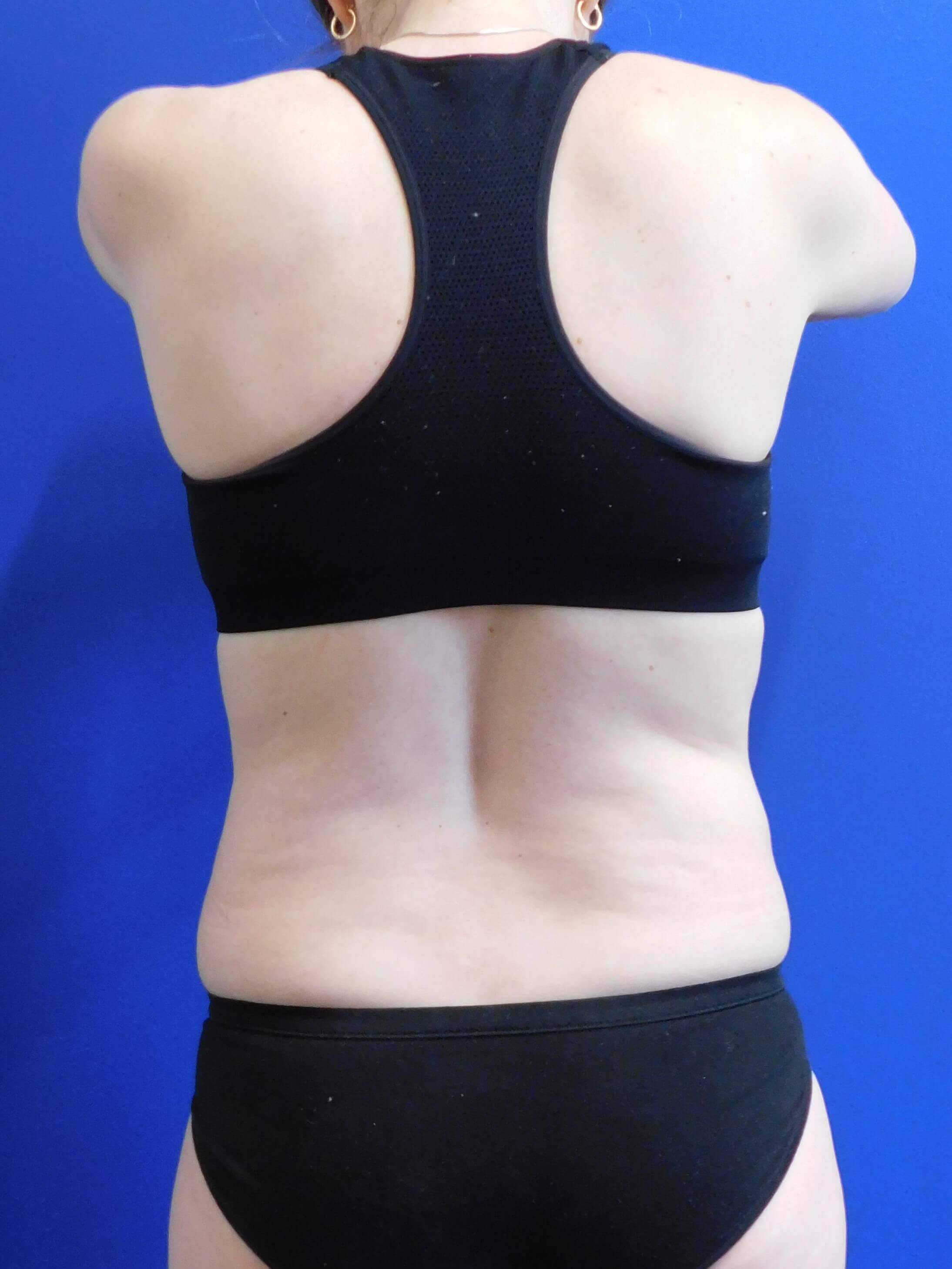 Sculpsure Fat Melting Laser Before