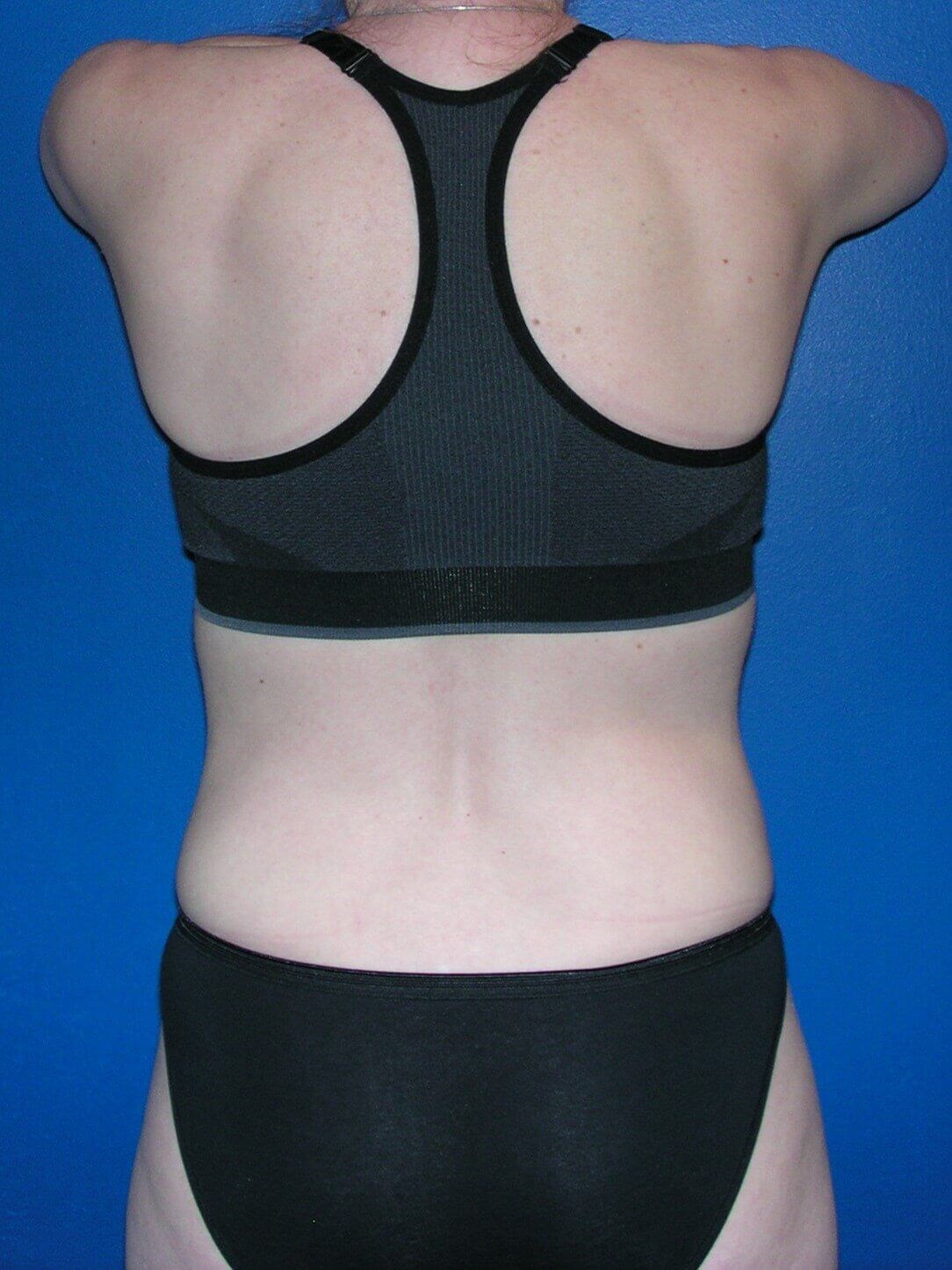 Sculpsure Fat Melting Laser After