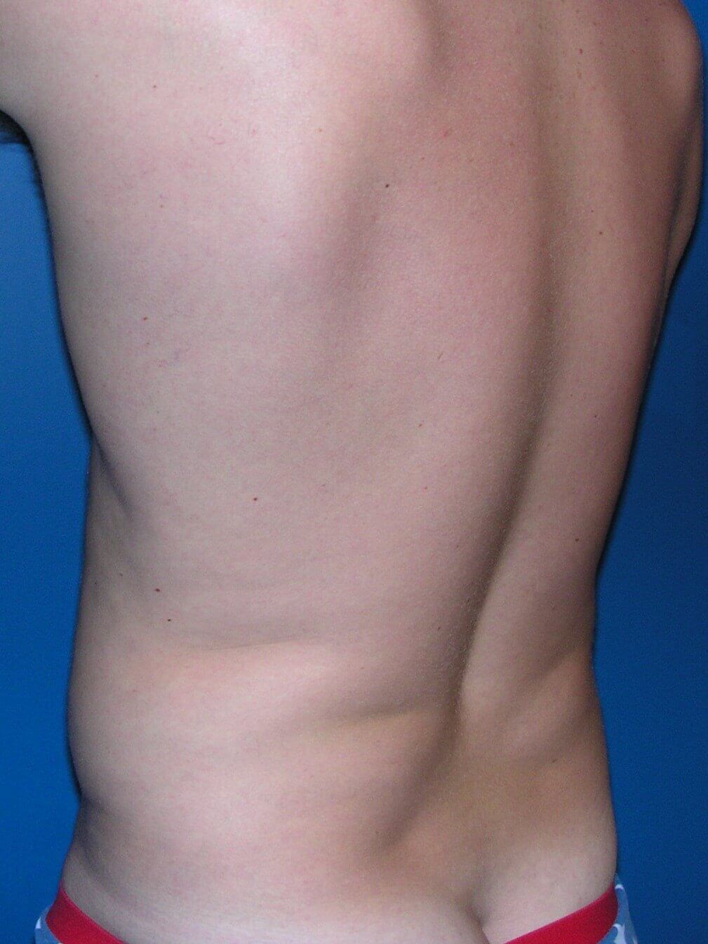 Sculpsure Before