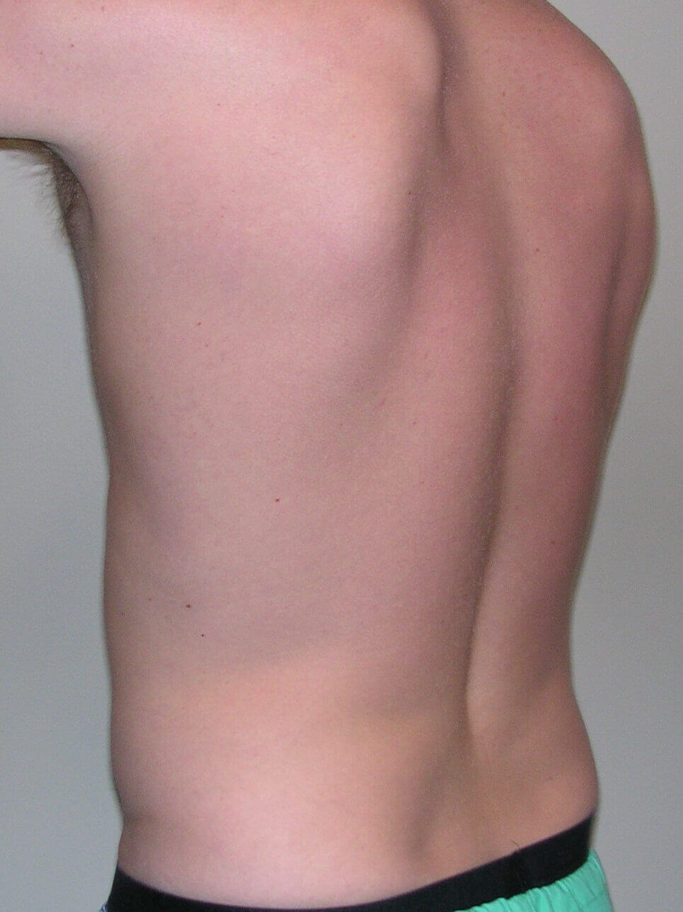 Sculpsure After