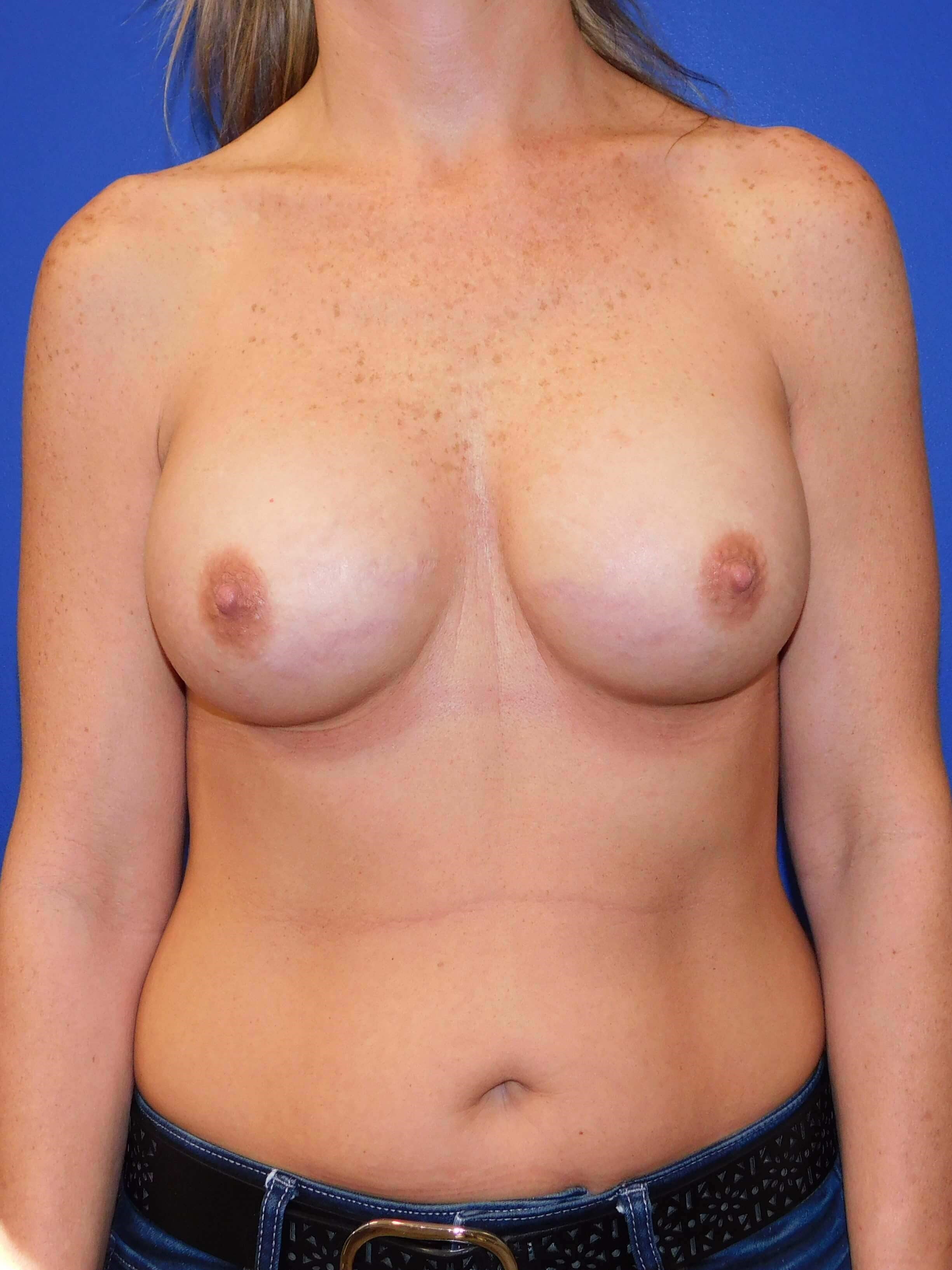 Breast Implants After