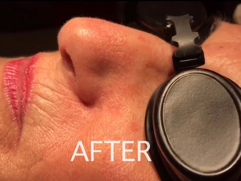 Laser Removal of Facial Veins After