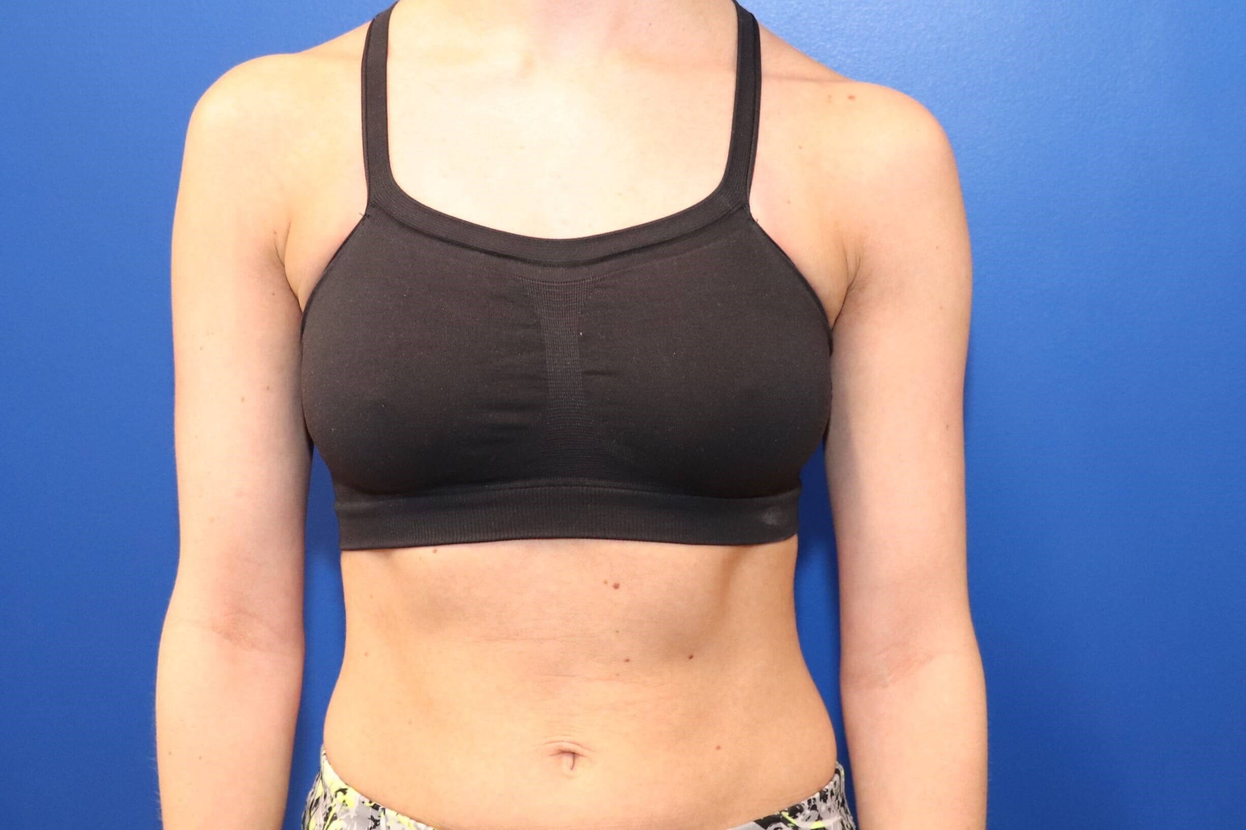 C cup Breast Augmentation Before