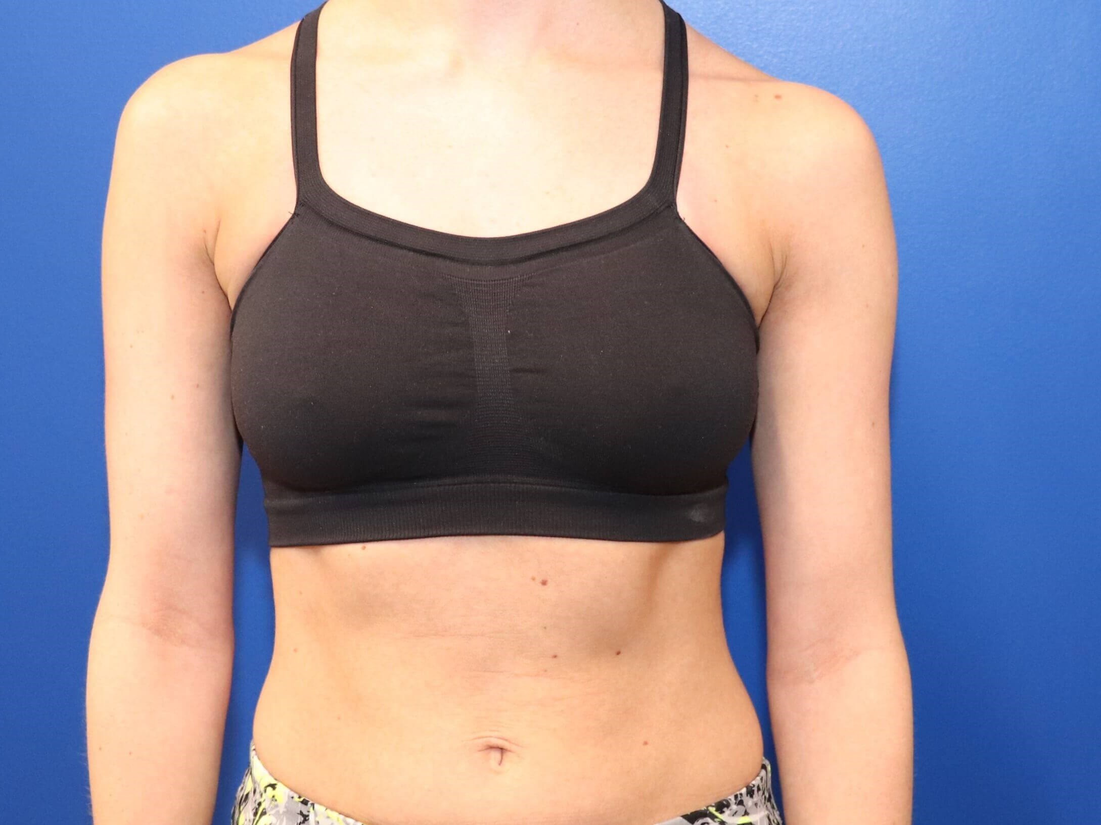 C cup Breast Augmentation Before
