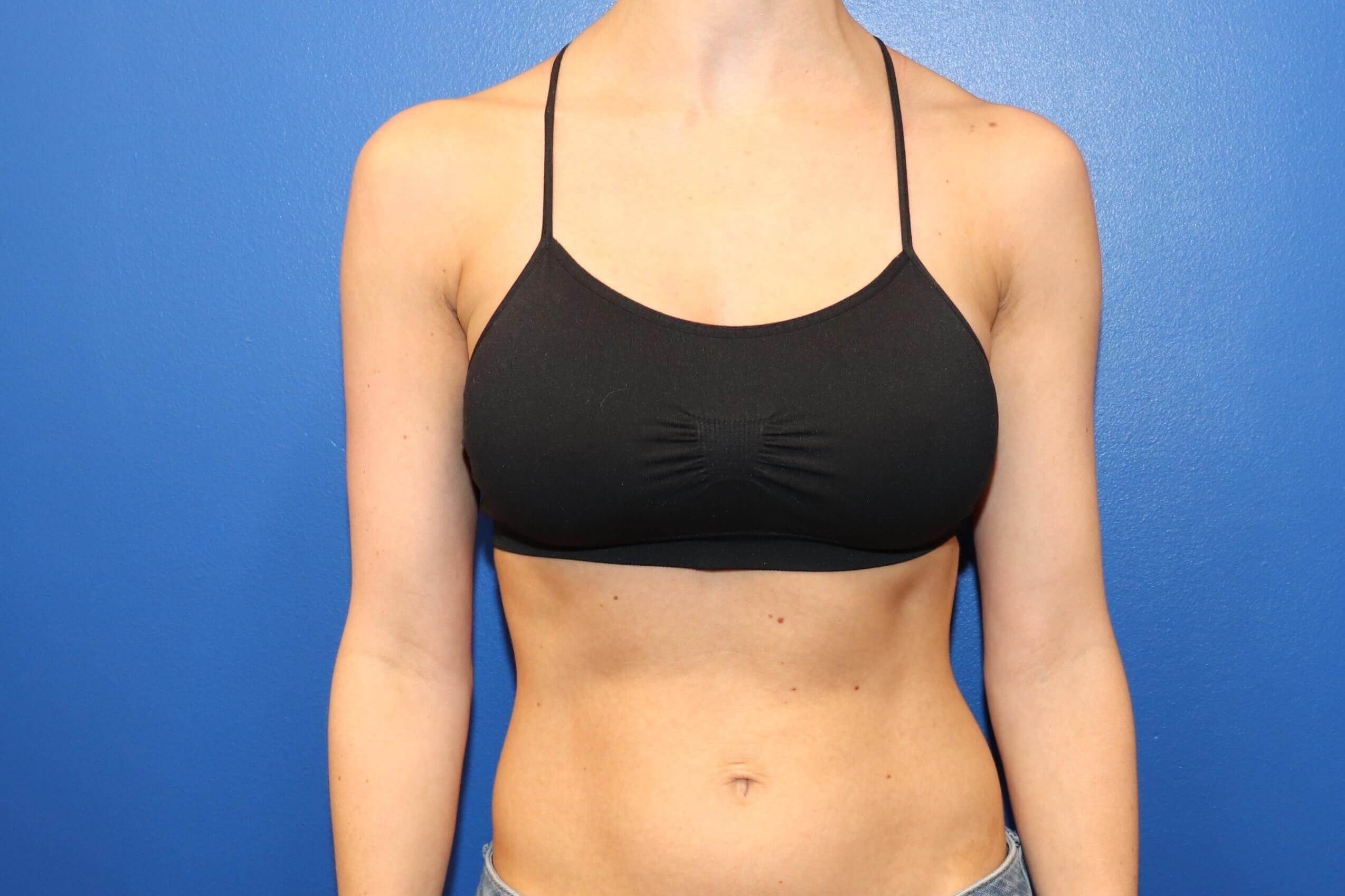 C cup Breast Augmentation After