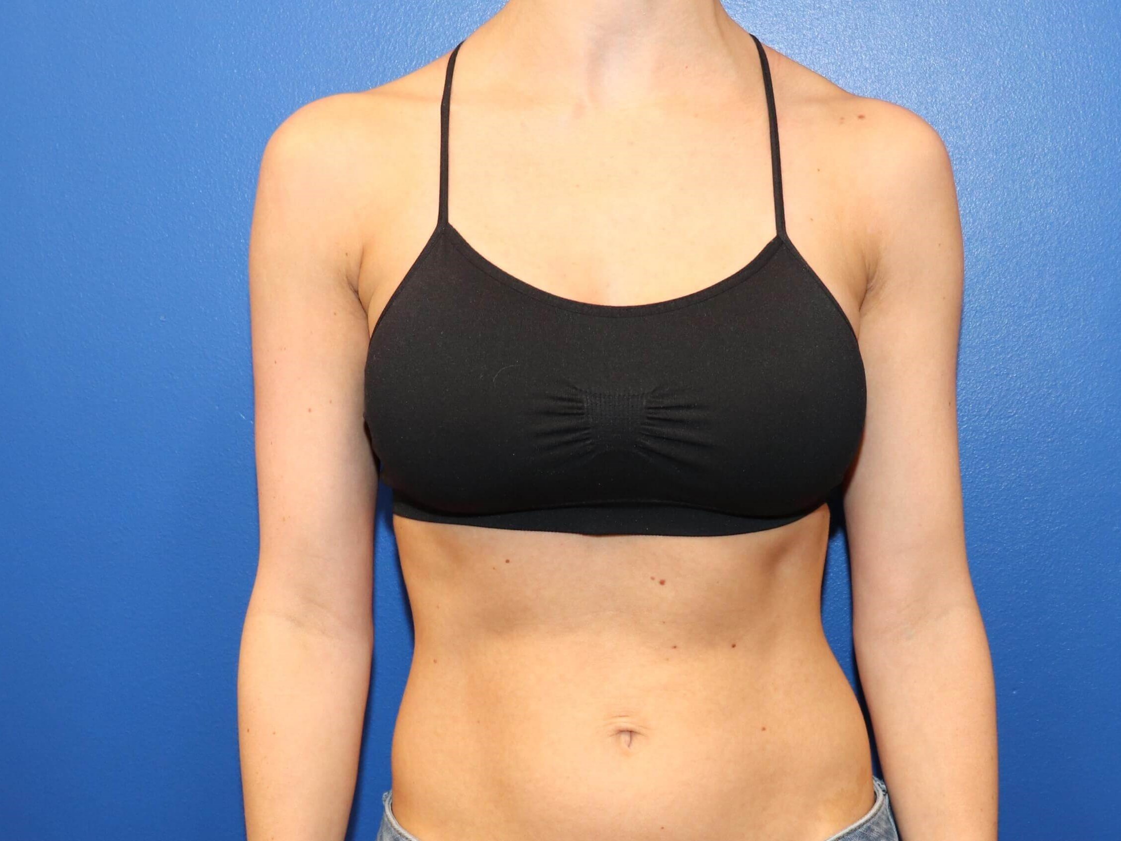 C cup Breast Augmentation After