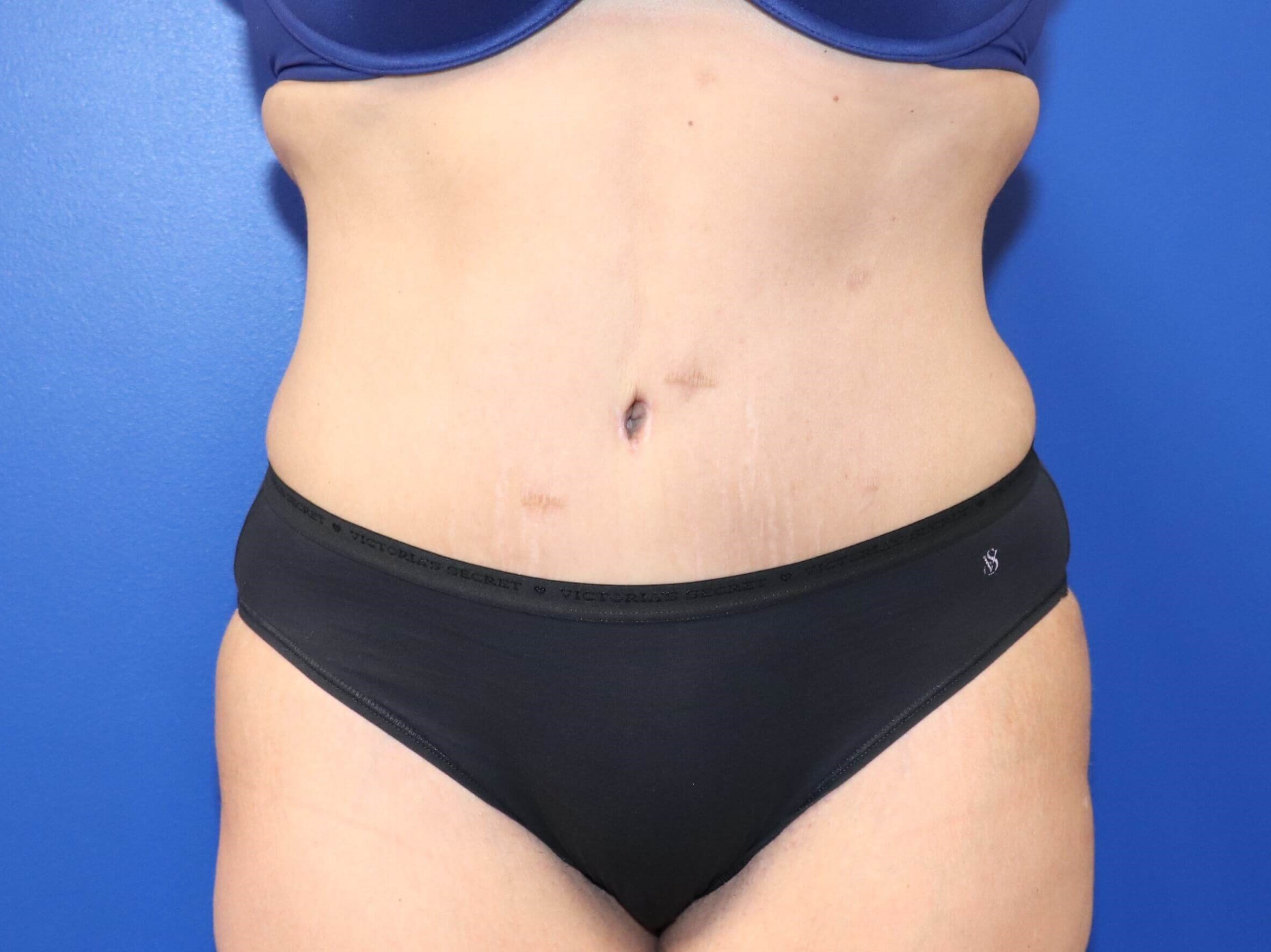 Tummy Tuck Mommy Makeover After