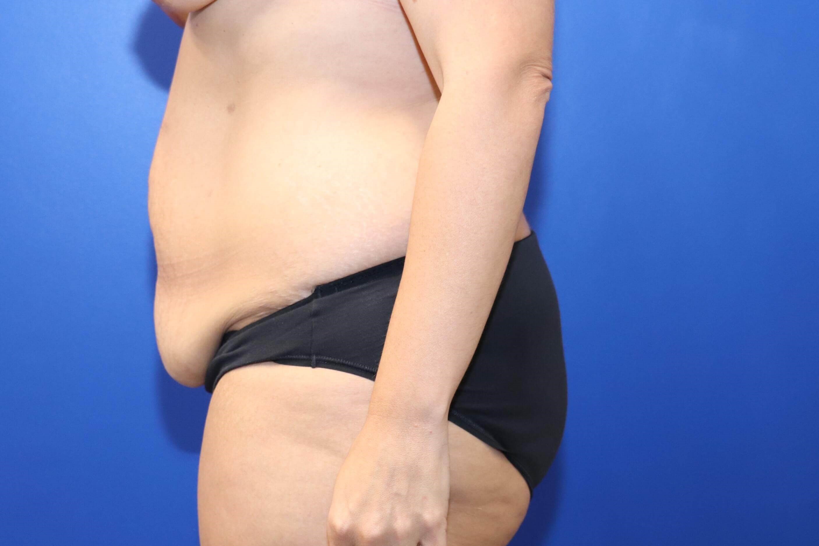 Tummy Tuck Abdominoplasty Before