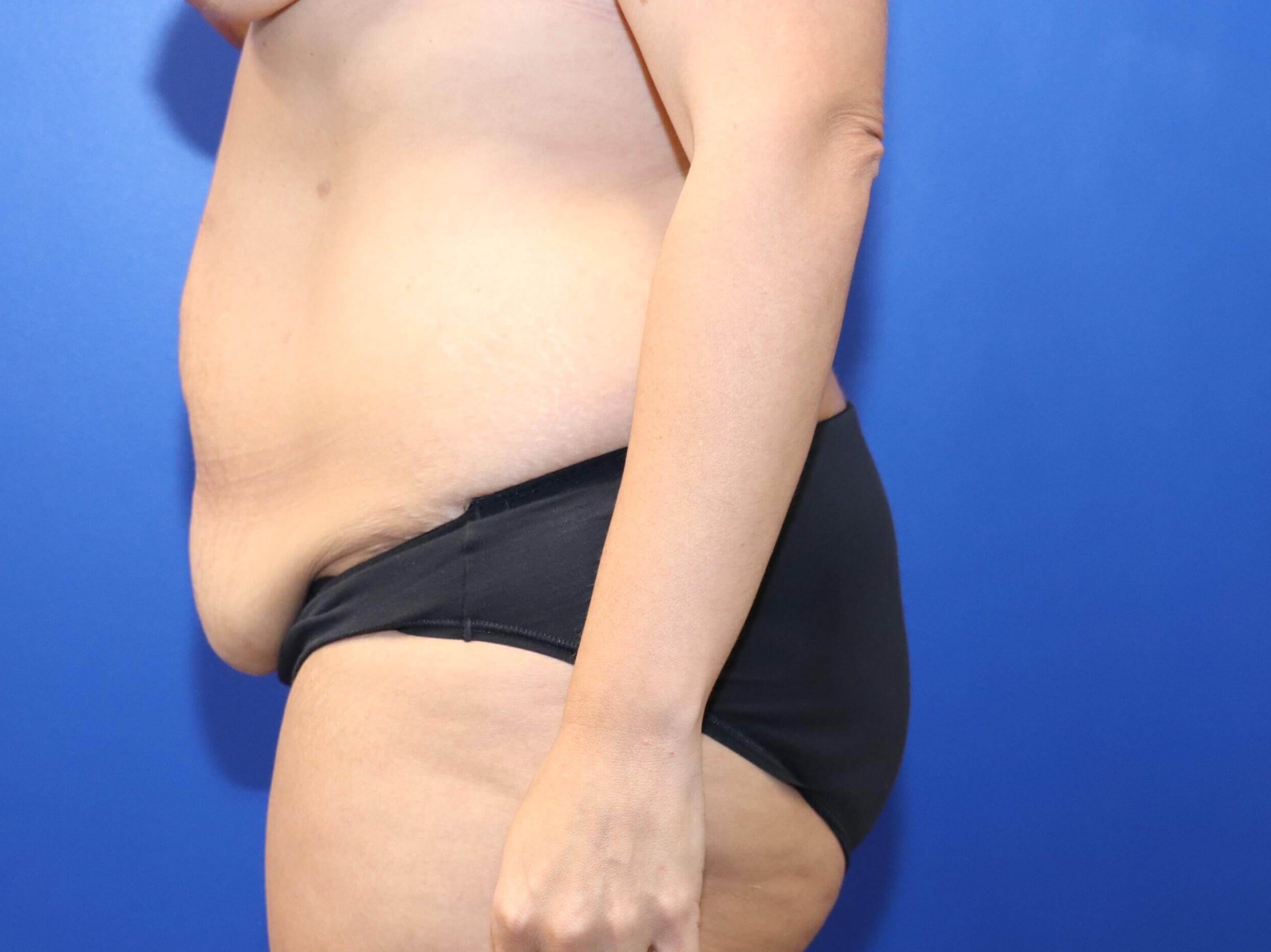 Tummy Tuck Abdominoplasty Before