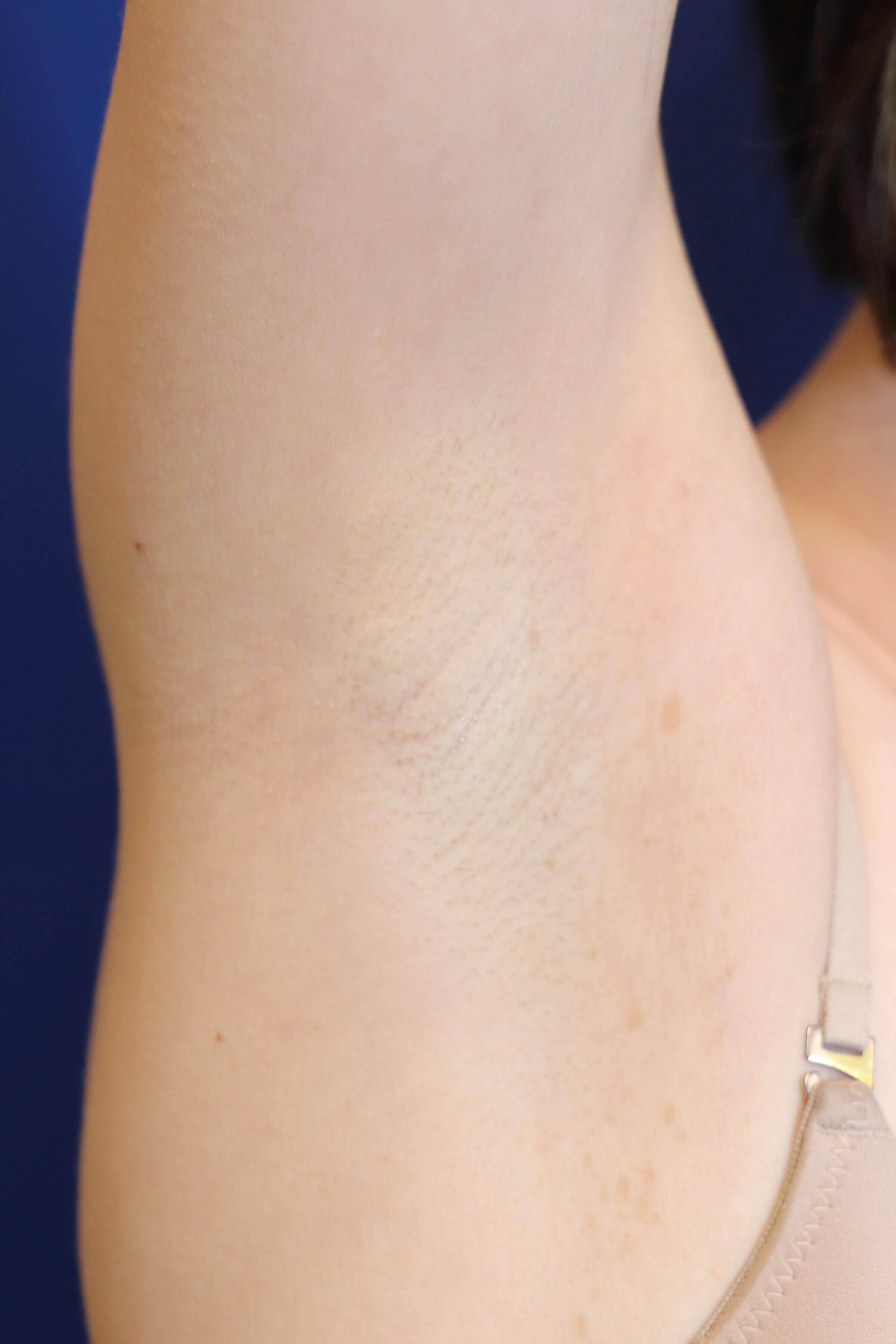 Before and After Laser Hair Removal Photos