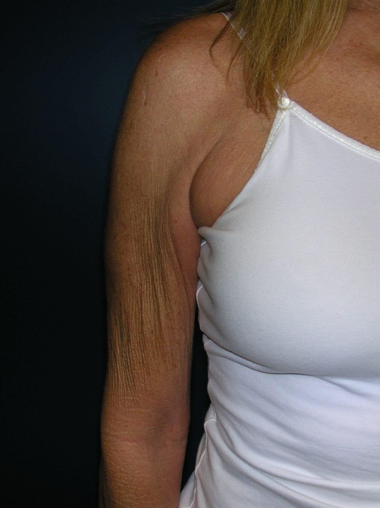 Upper Arm Lift Before
