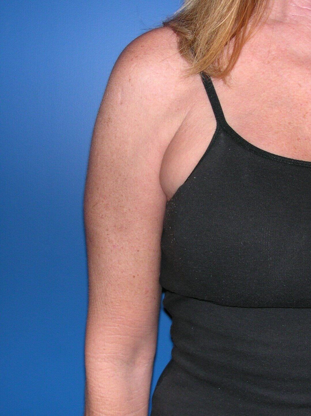Upper Arm Lift After