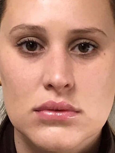 Lip Filler and Microneedling After