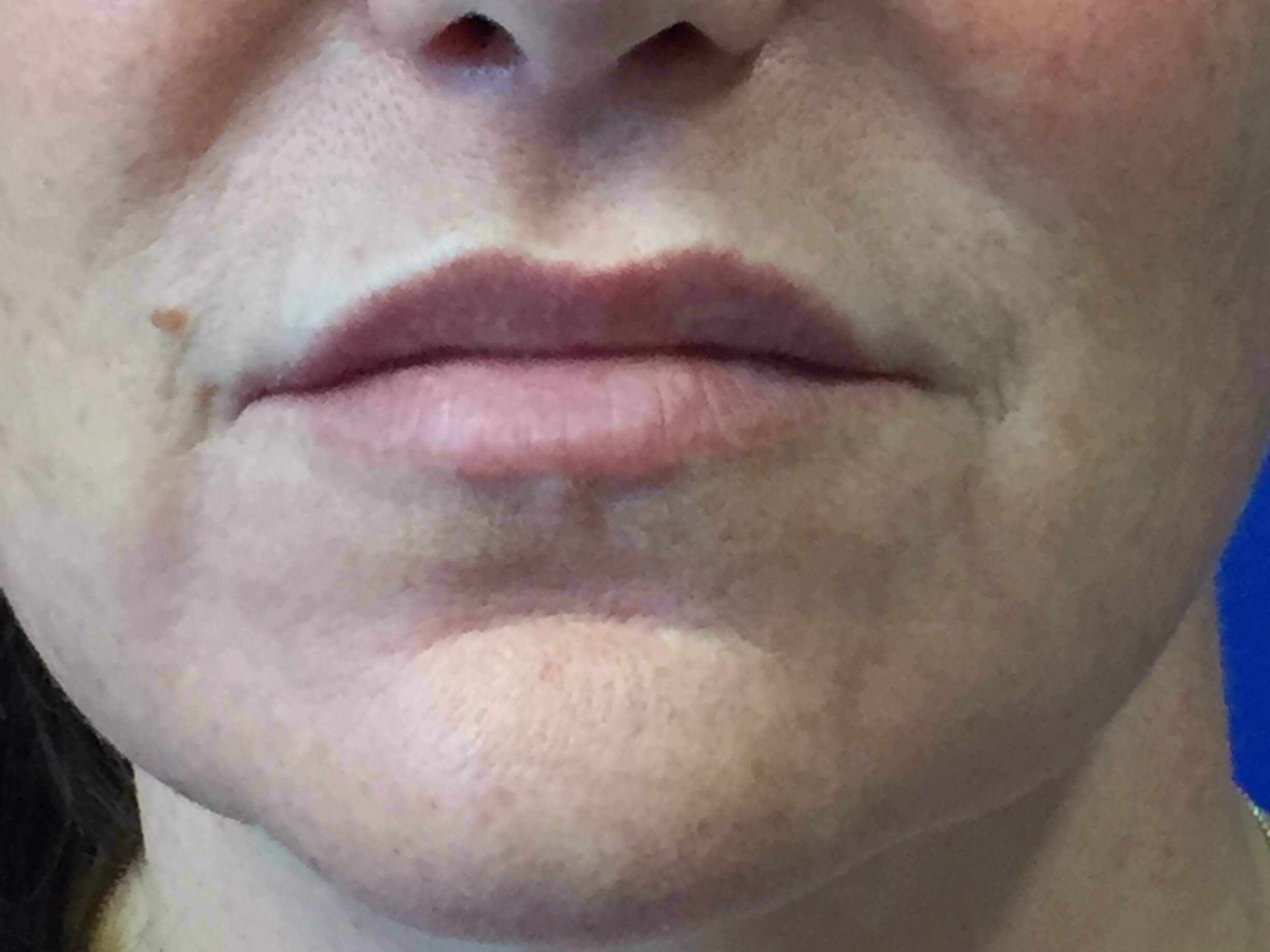 Lip Enhancement with Filler Before