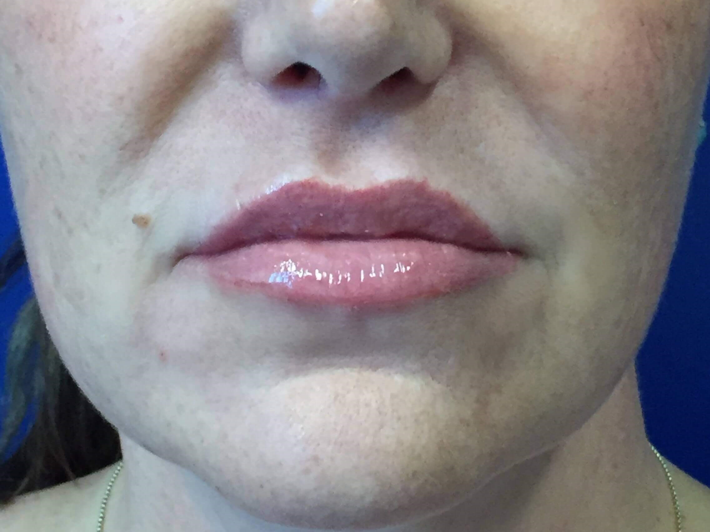 Lip Enhancement with Filler After