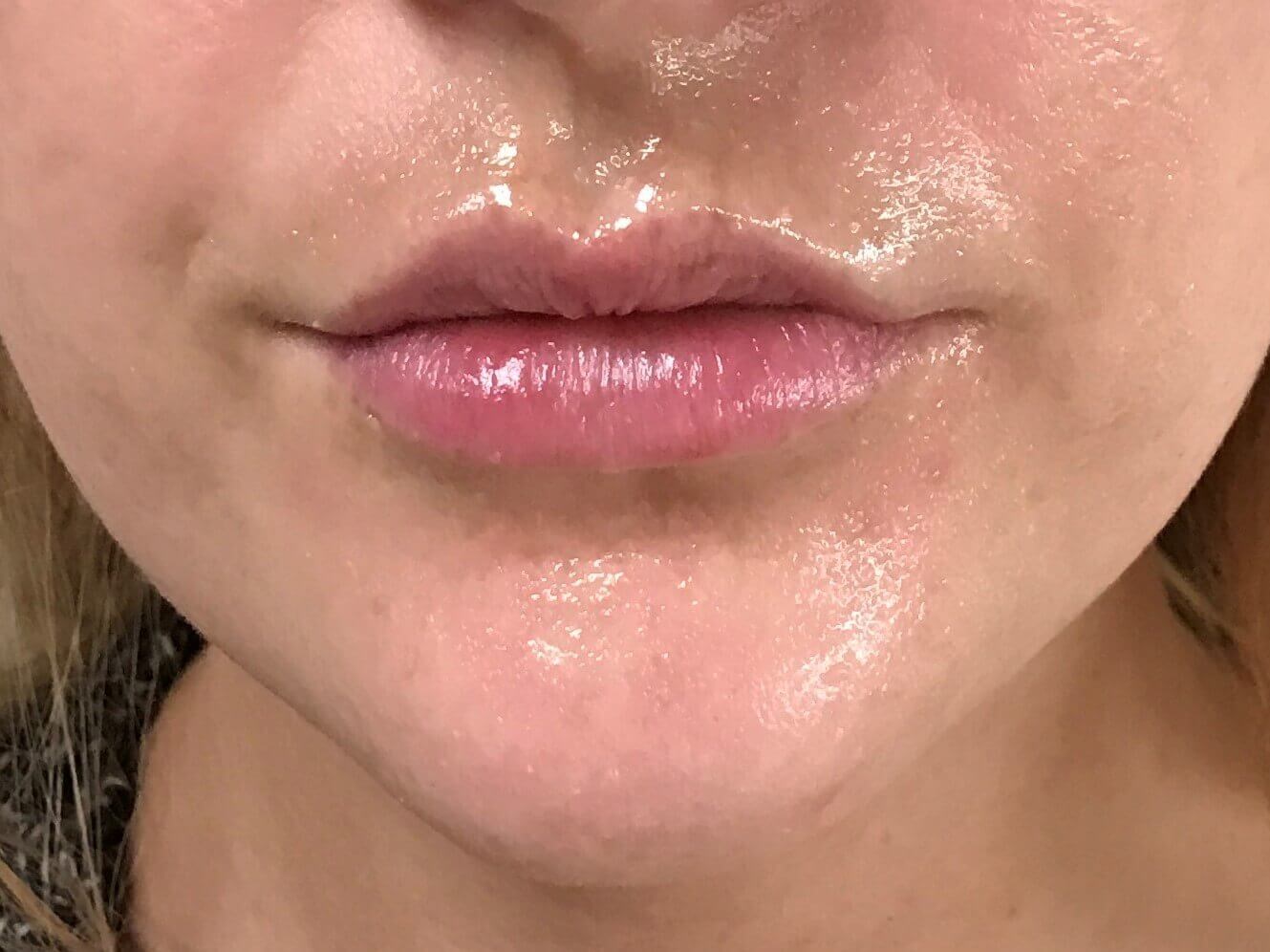 Lip Enhancement with Filler Before