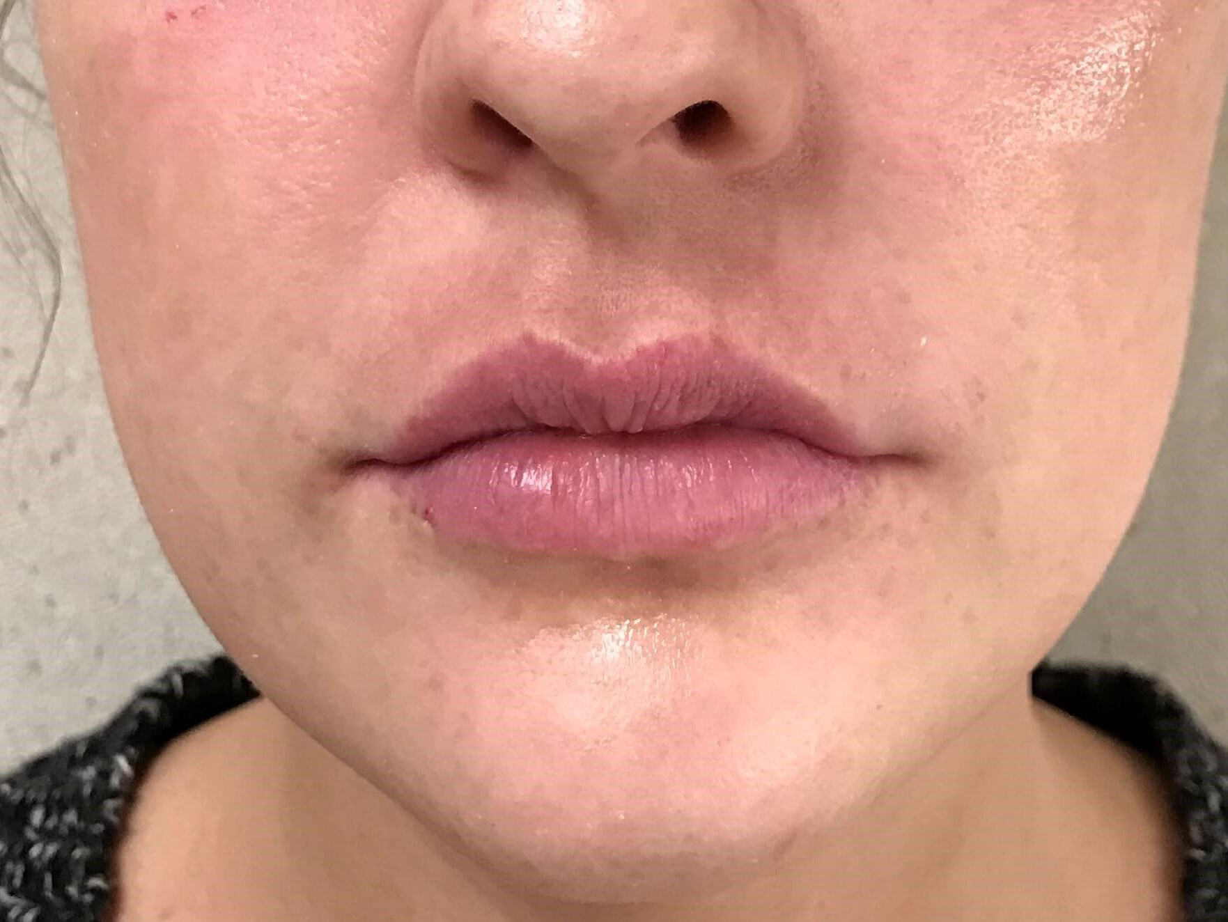 Lip Enhancement with Filler After