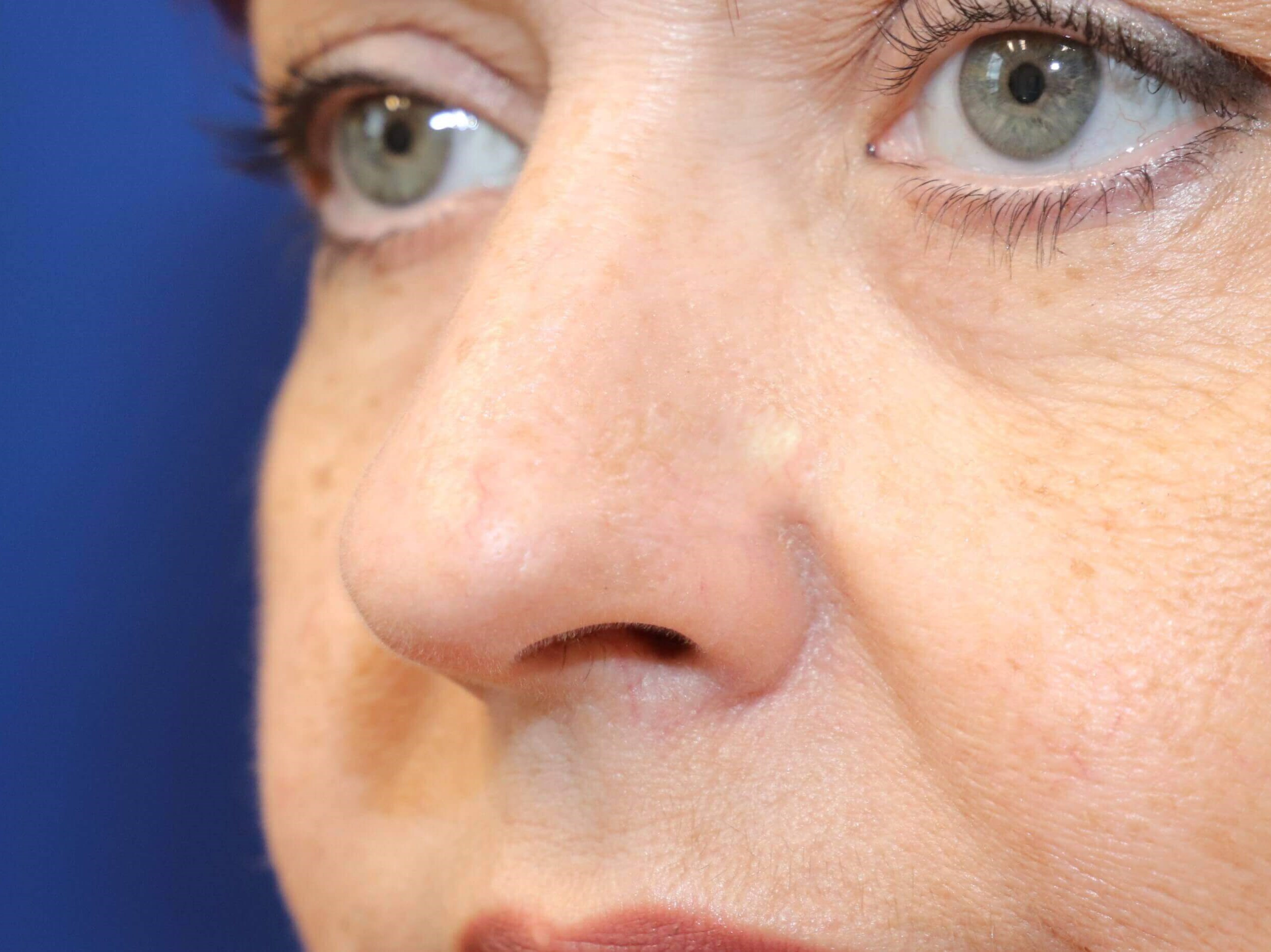 Laser Removal of Facial Veins After