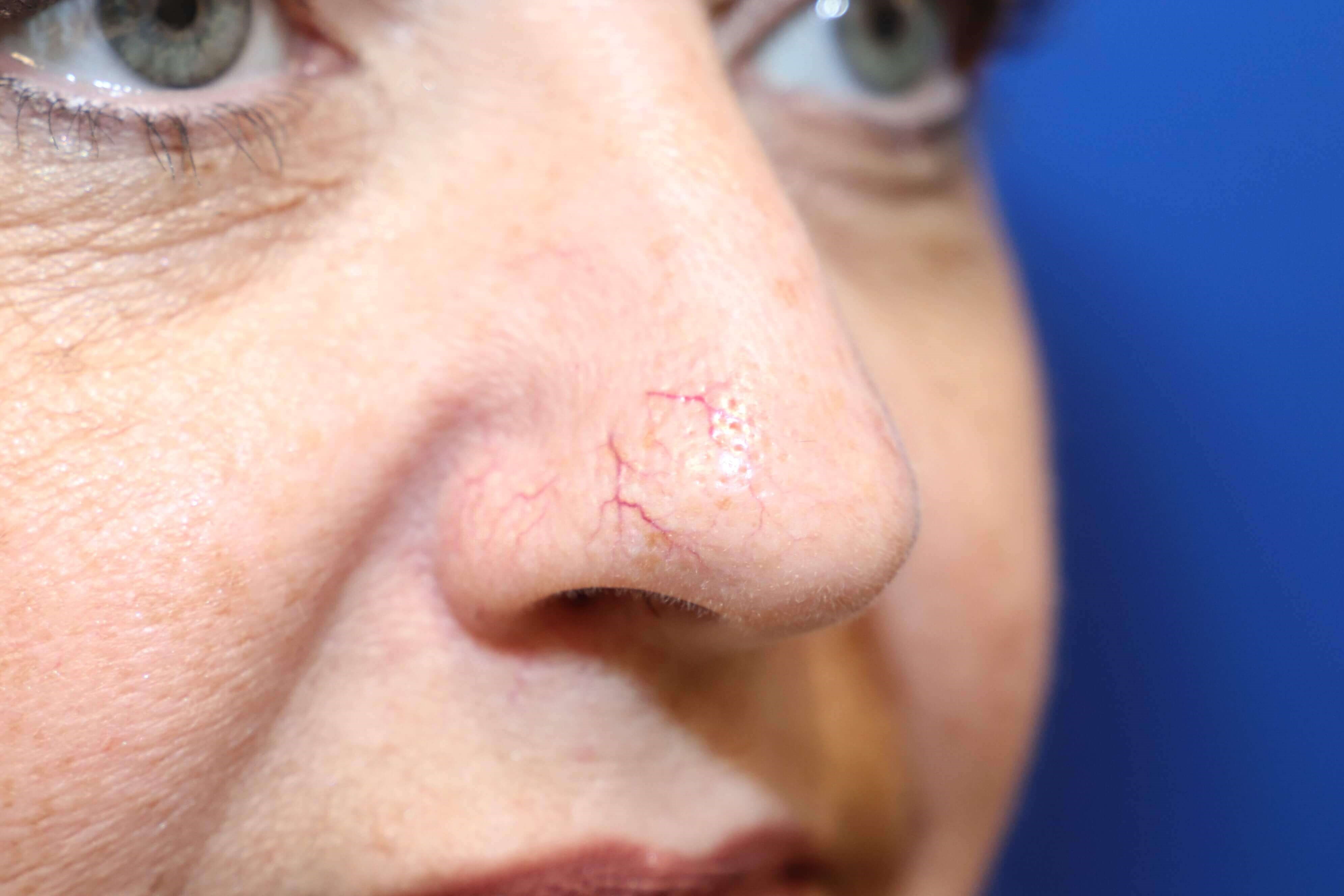 Laser Removal of Facial Veins Before