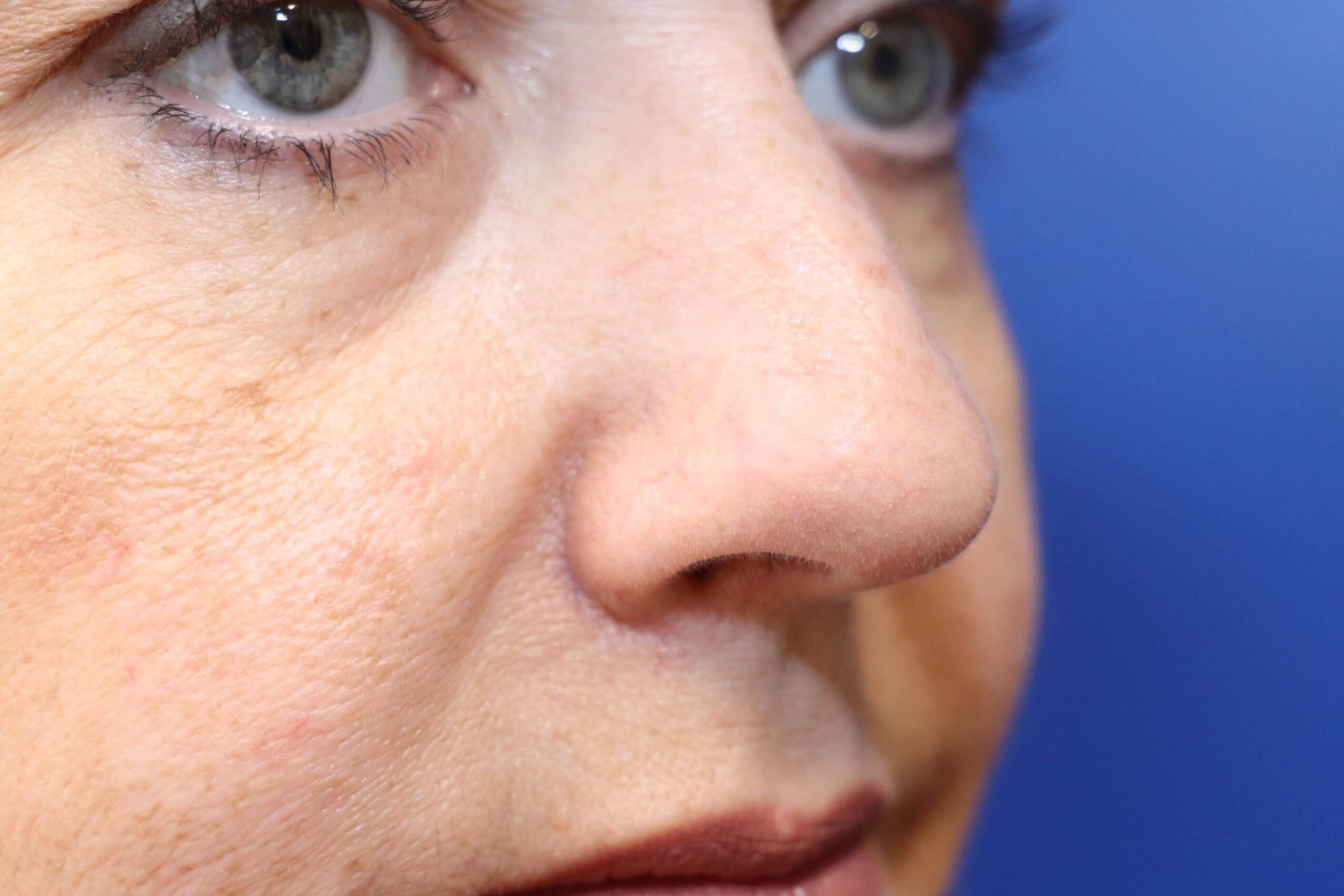 Laser Removal of Facial Veins After
