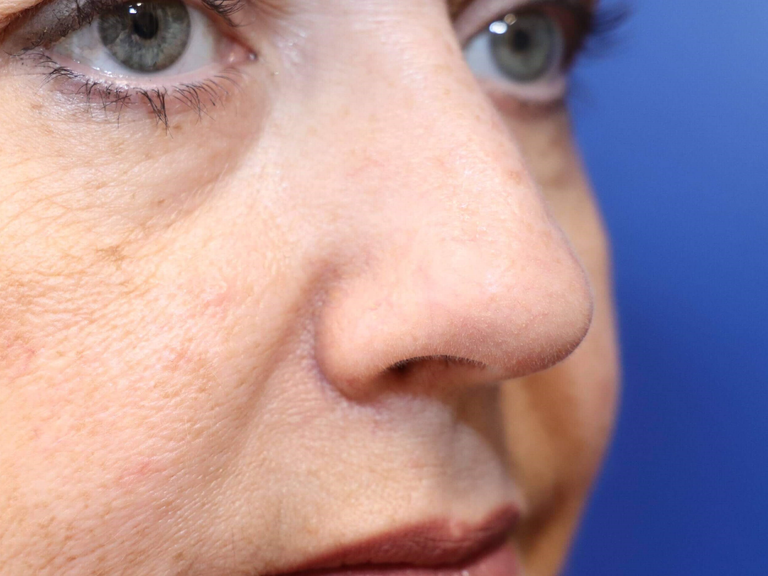 Laser Removal of Facial Veins After