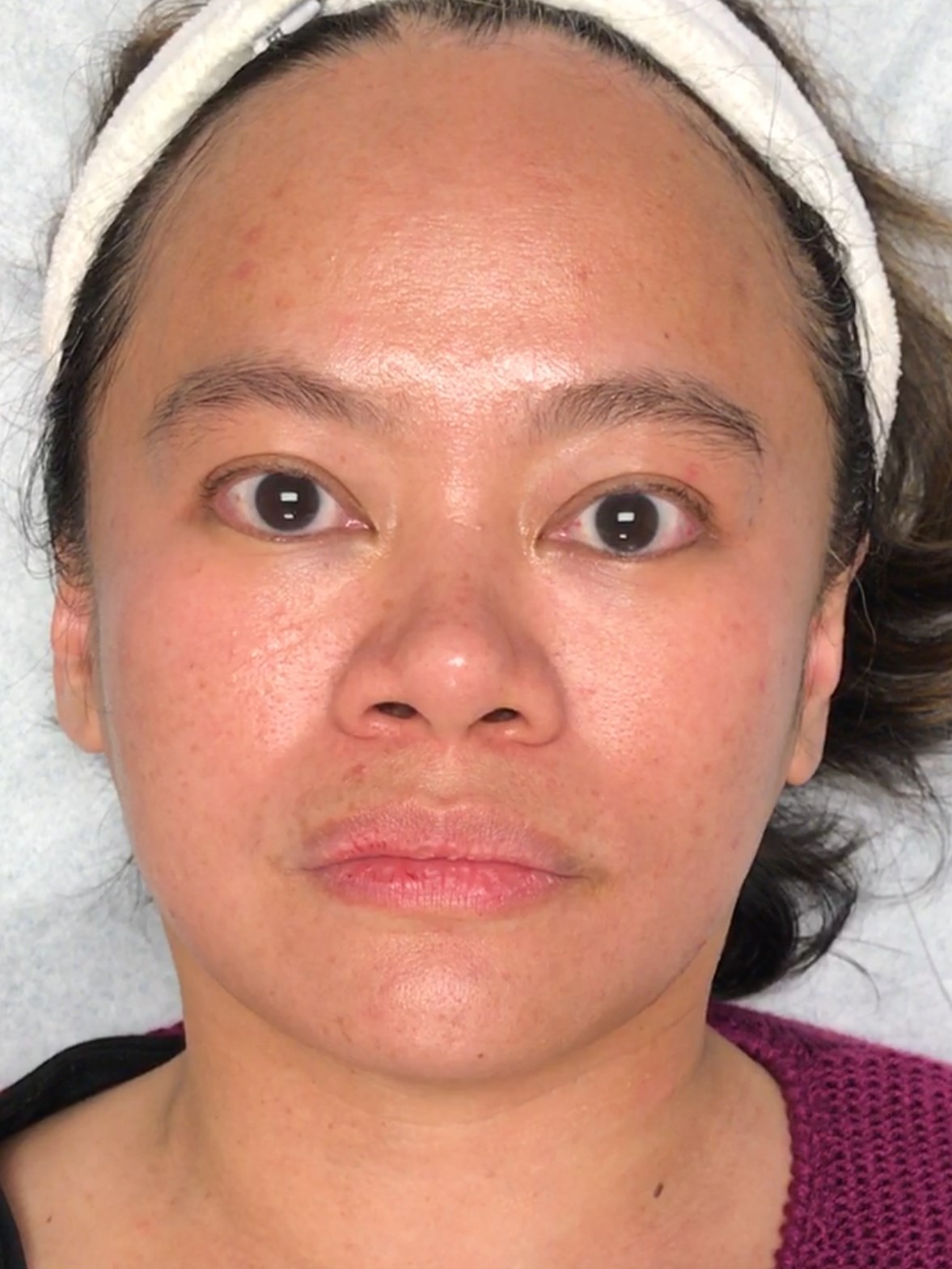 Microneedling Micro-Needling After