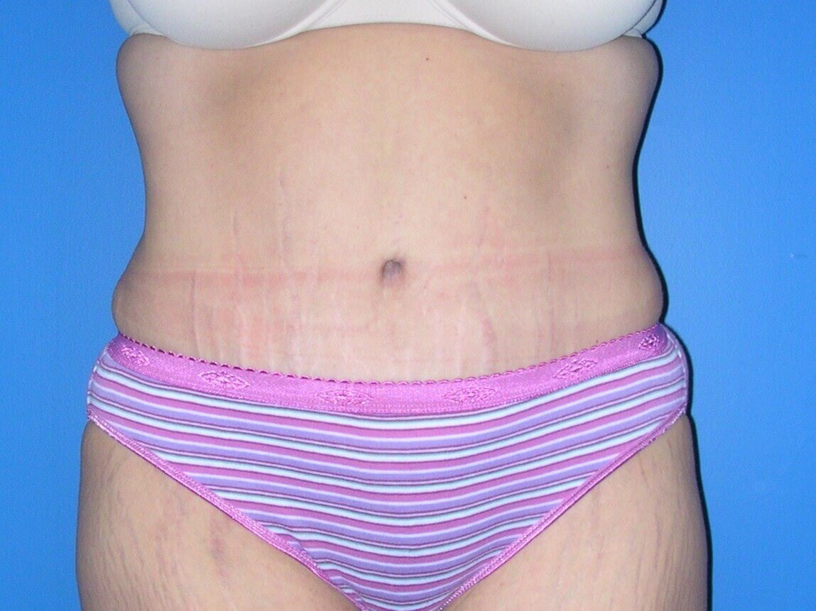 Tummy Tuck Abdominoplasty After