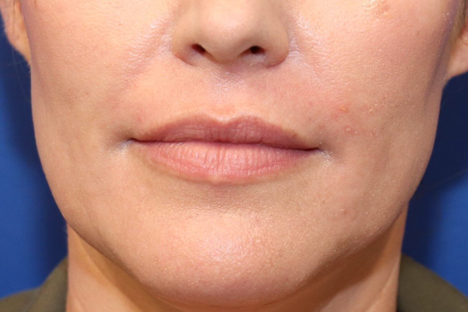 Lip Enhancement with Filler Before