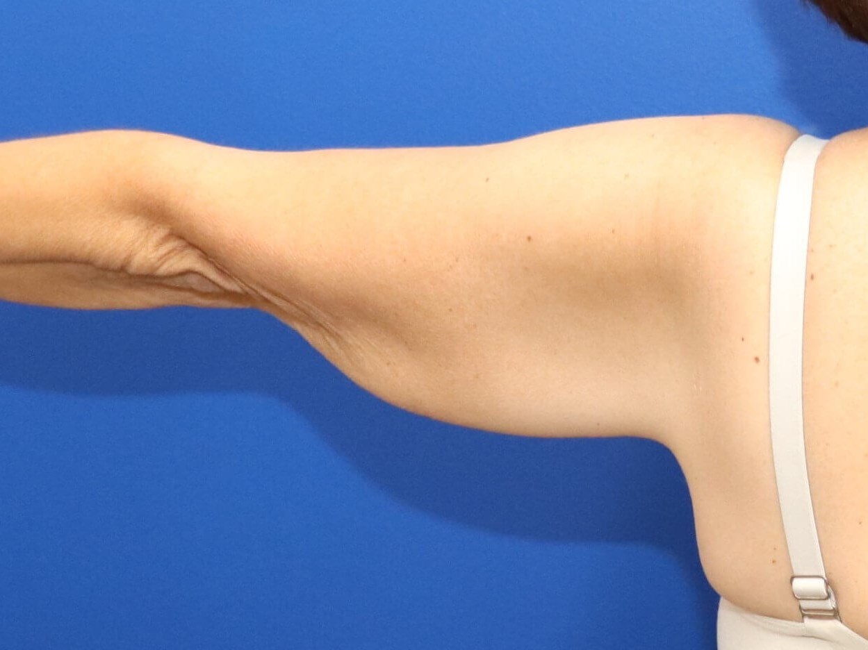 Arm Lift Brachioplasty Before