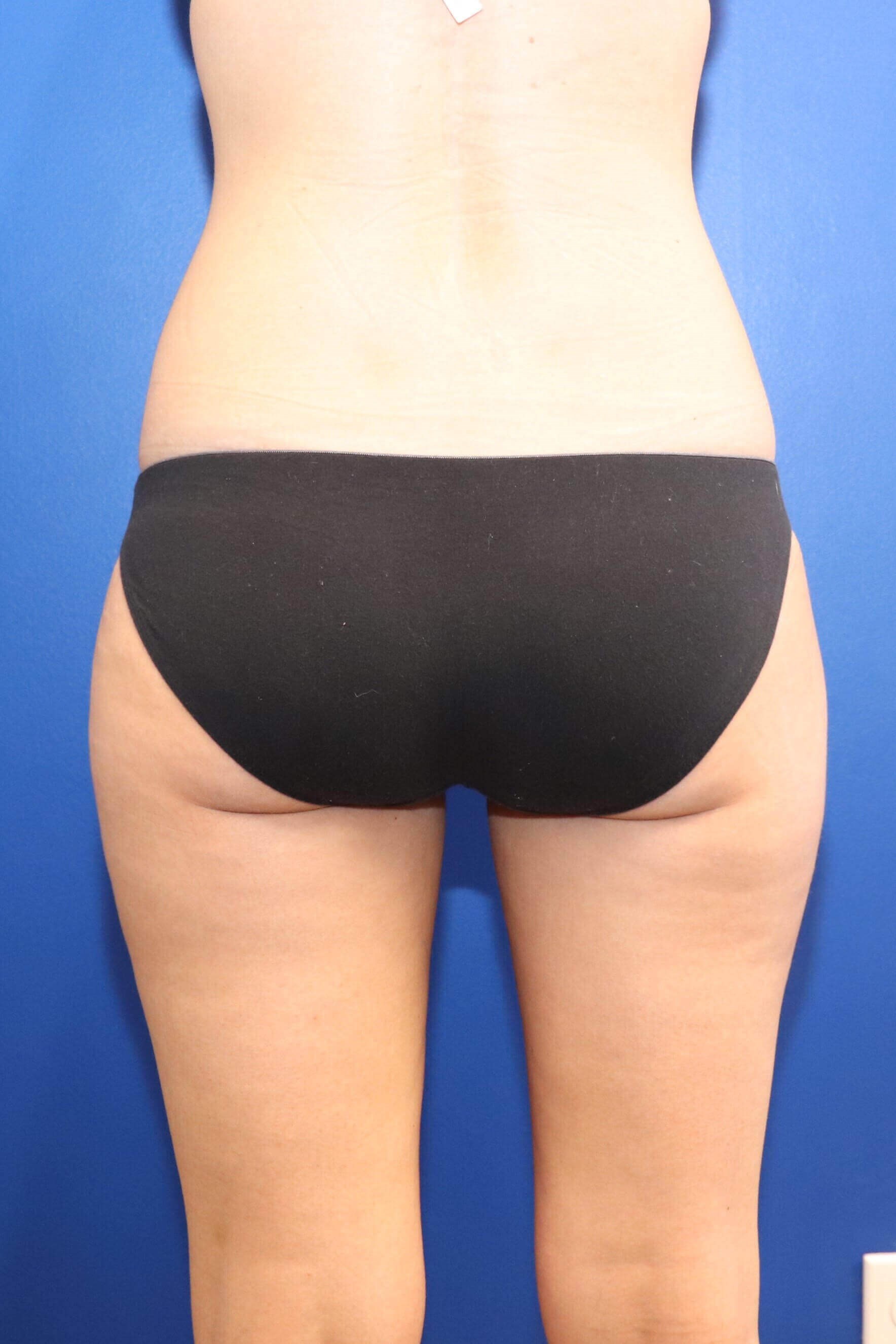 Sculpsure Fat Melting Laser After