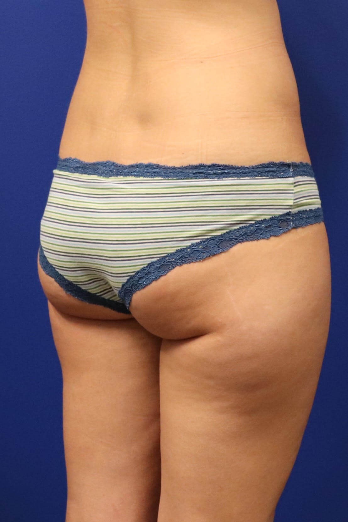 Sculpsure Fat Melting Laser Before