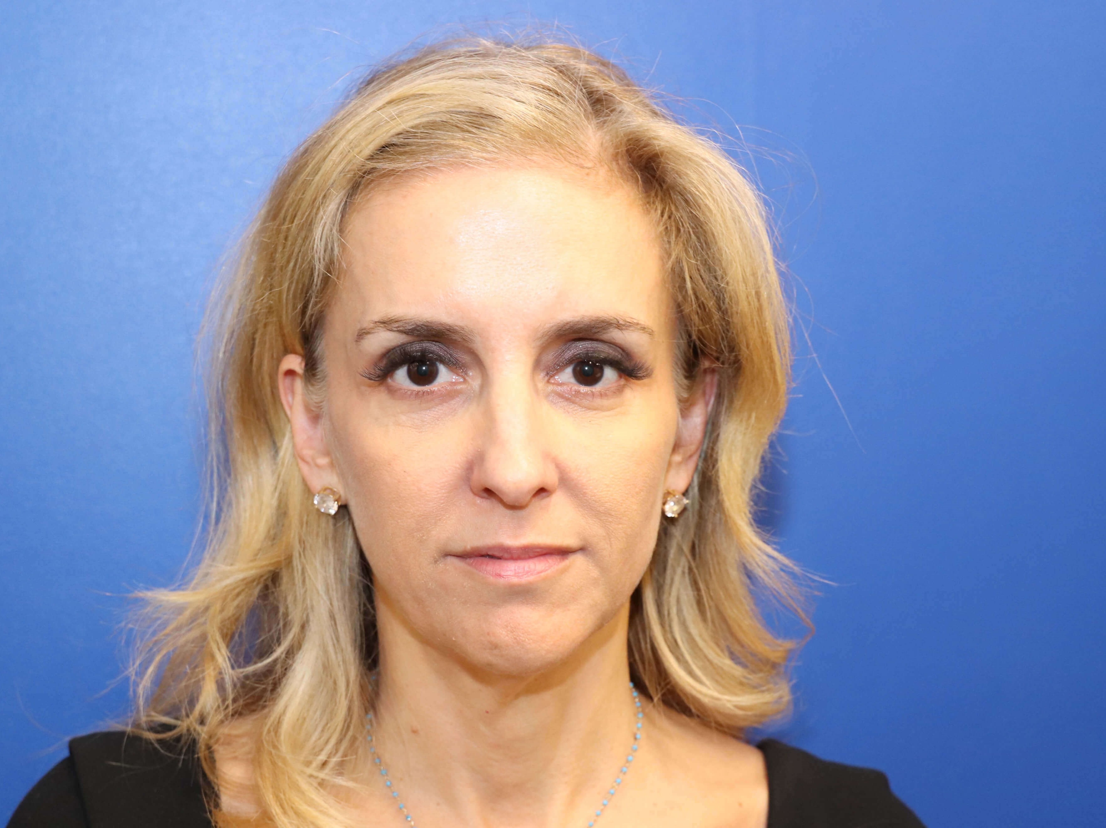 Liquid Facelift with Restylane After