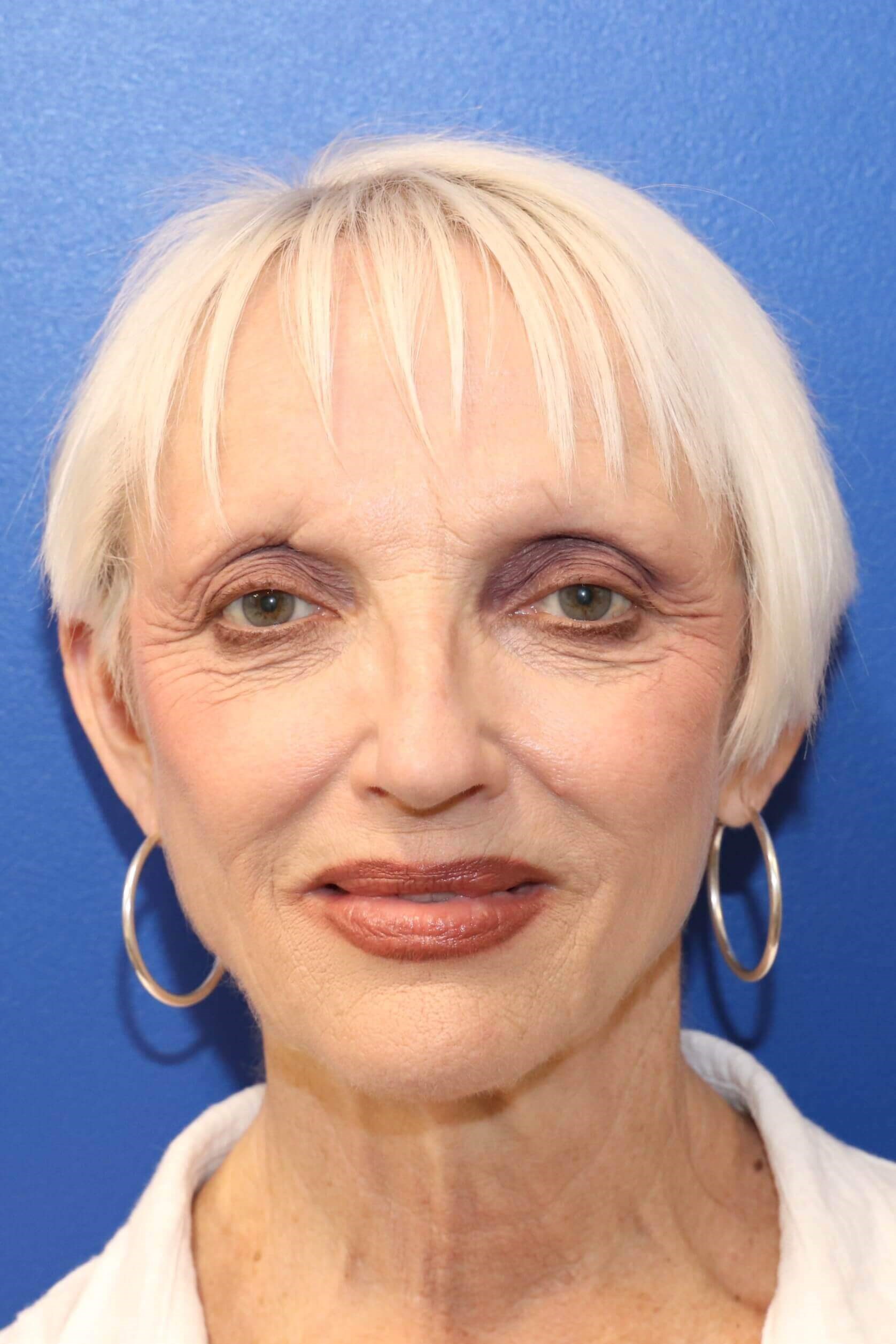 Liquid Facelift with Restylane After