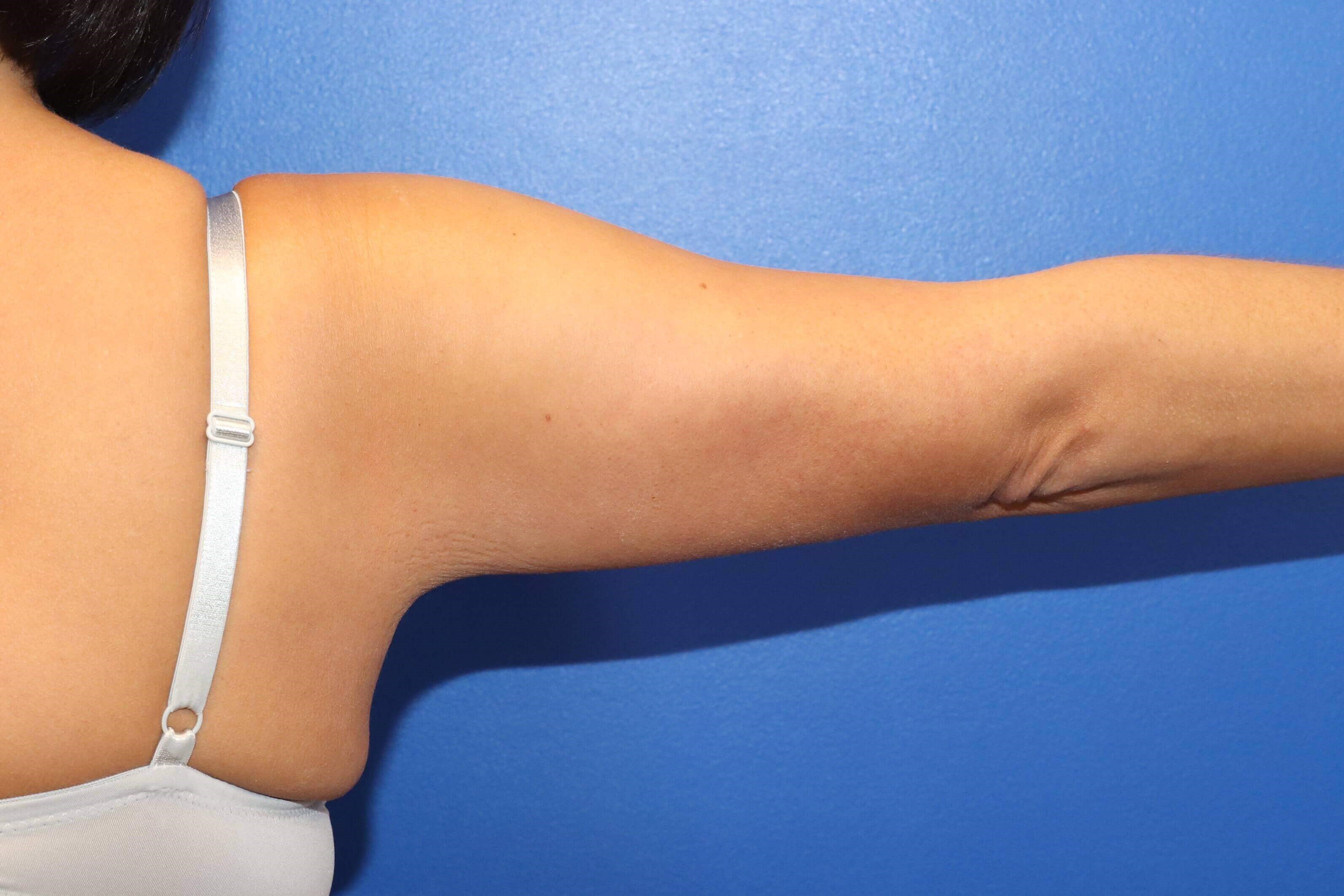 Arm Lift Brachioplasty After