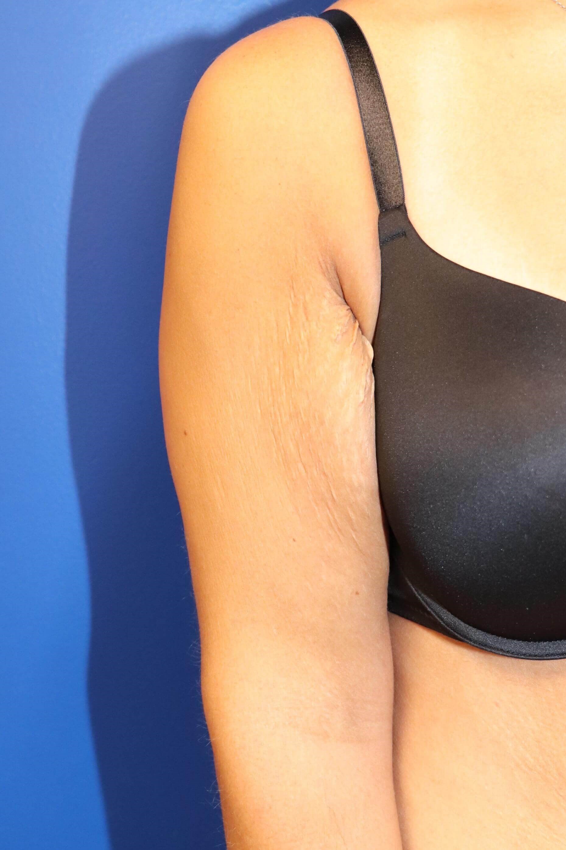 Arm Lift Brachioplasty Before