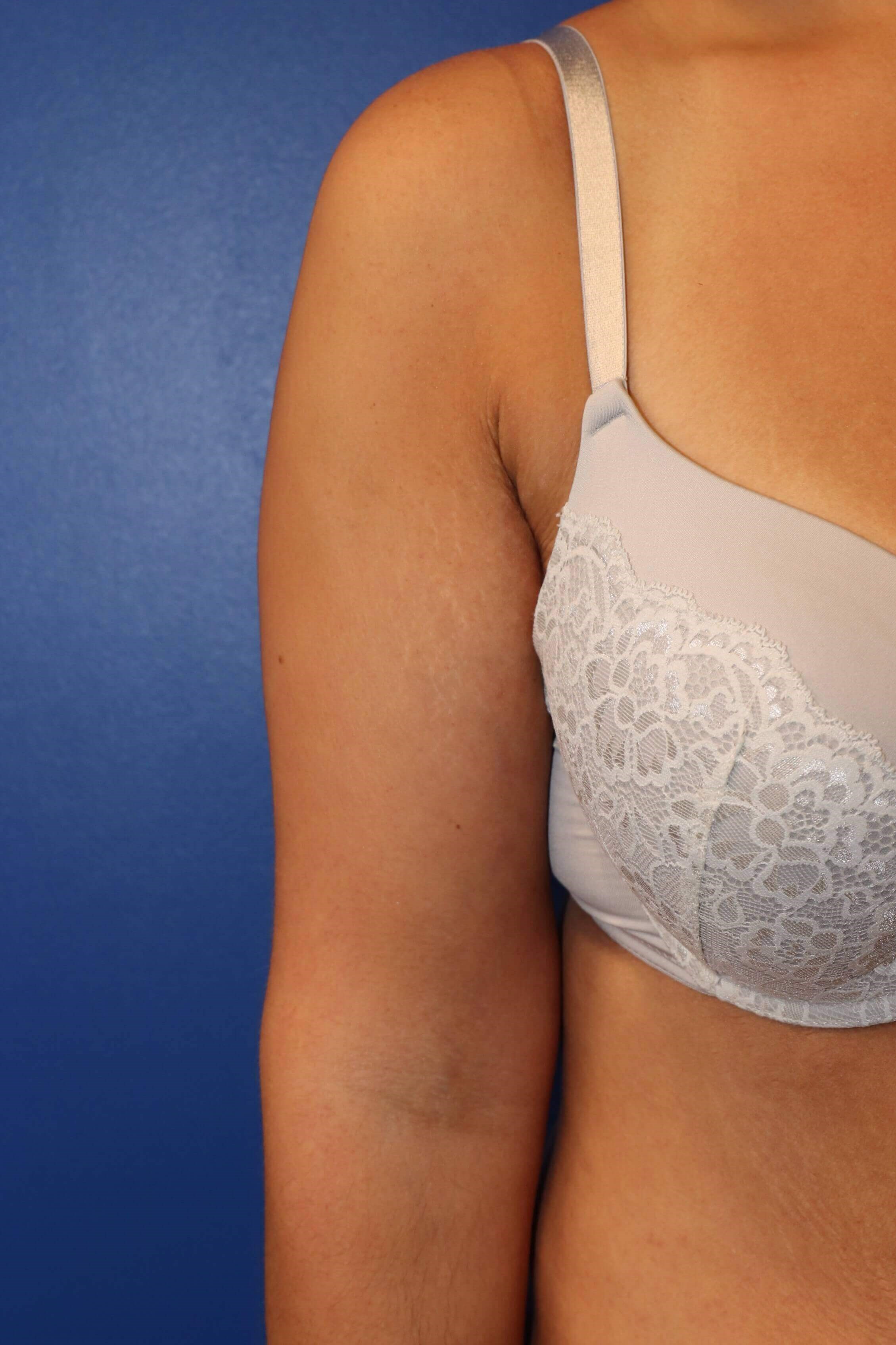 Arm Lift Brachioplasty After