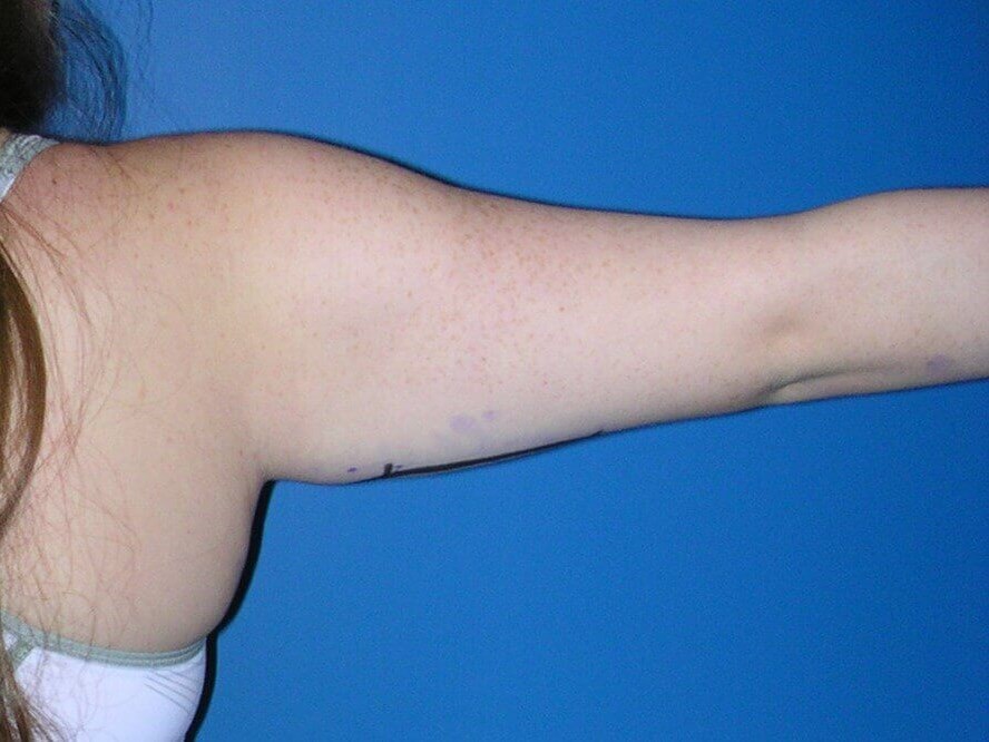 Arm Lift Brachioplasty Before