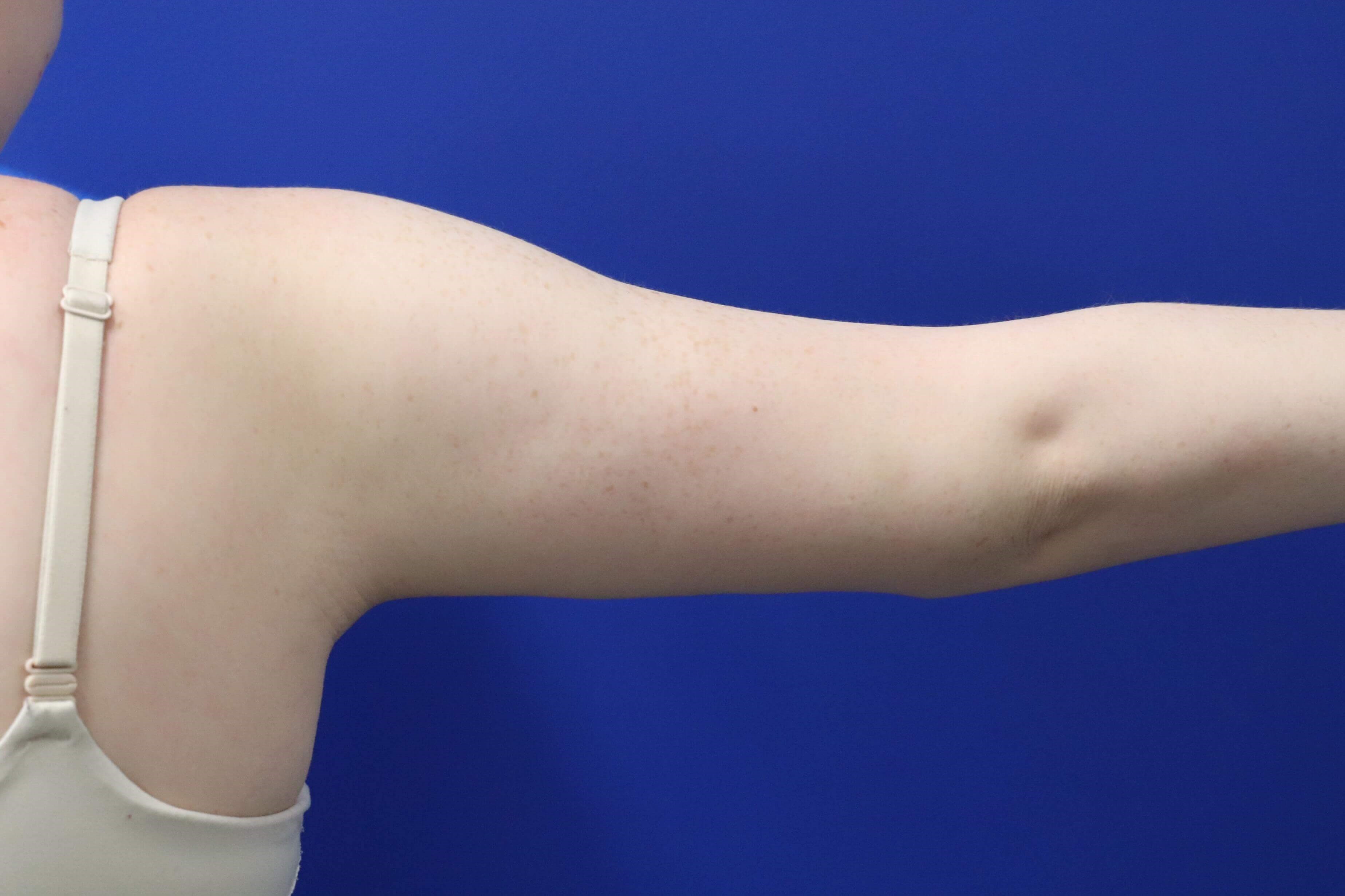 Arm Lift Brachioplasty After