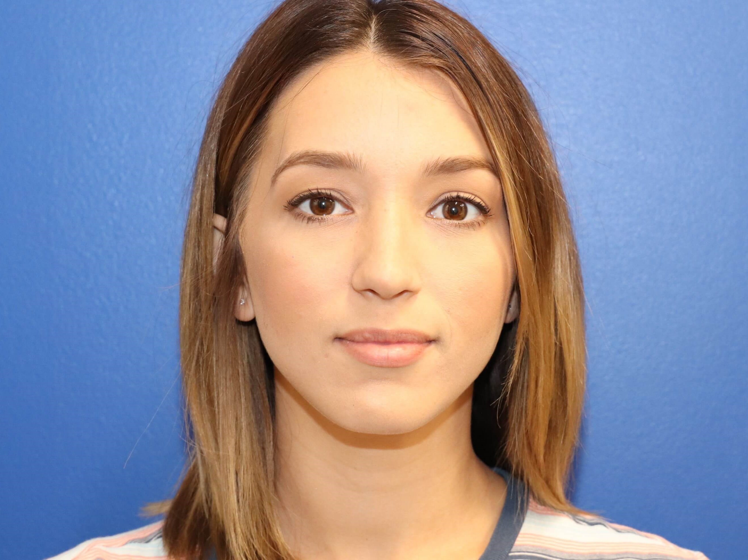 Lower Eyelid Surgery After
