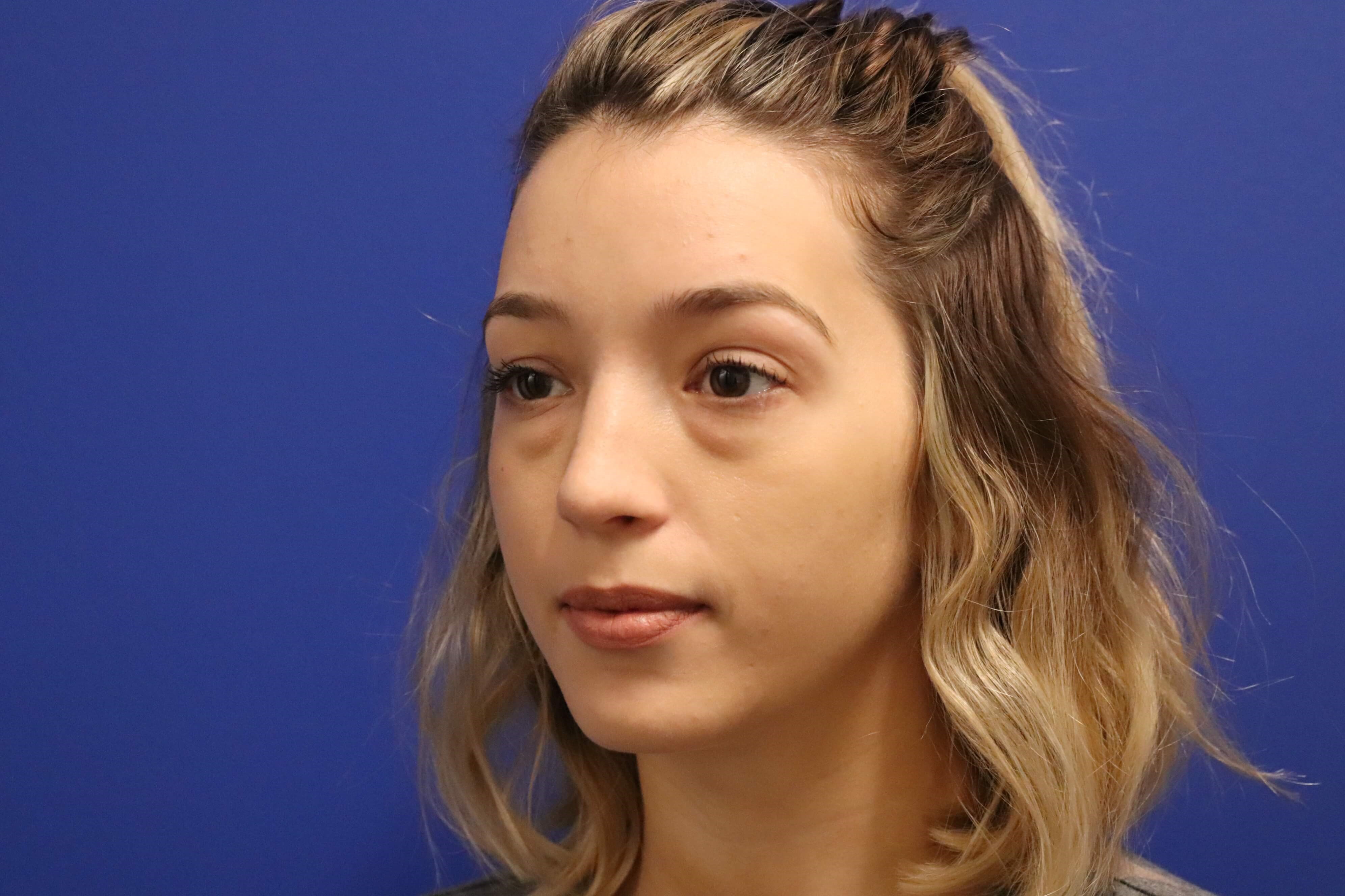 Lower Eyelid Surgery Before