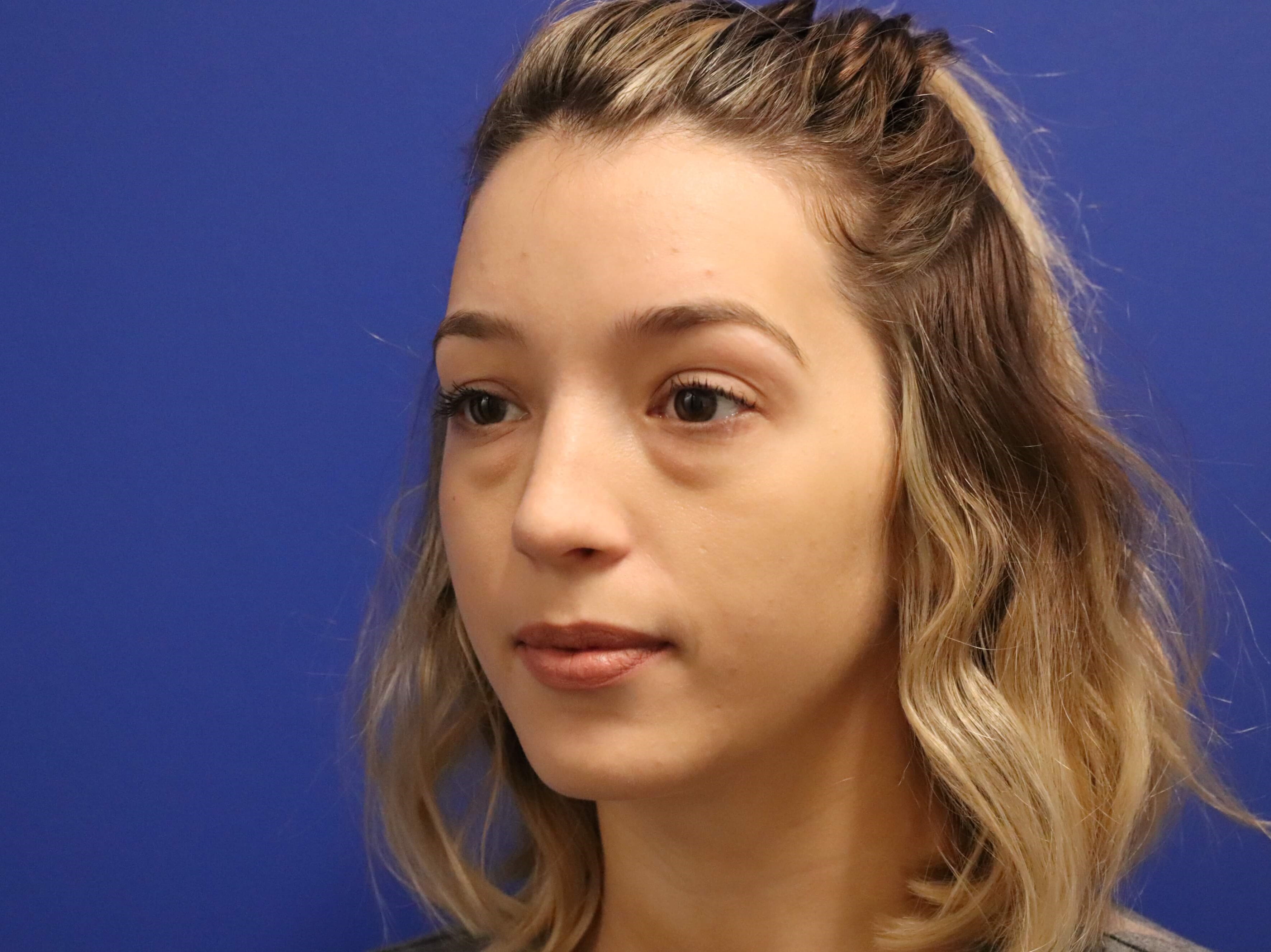 Lower Eyelid Surgery Before
